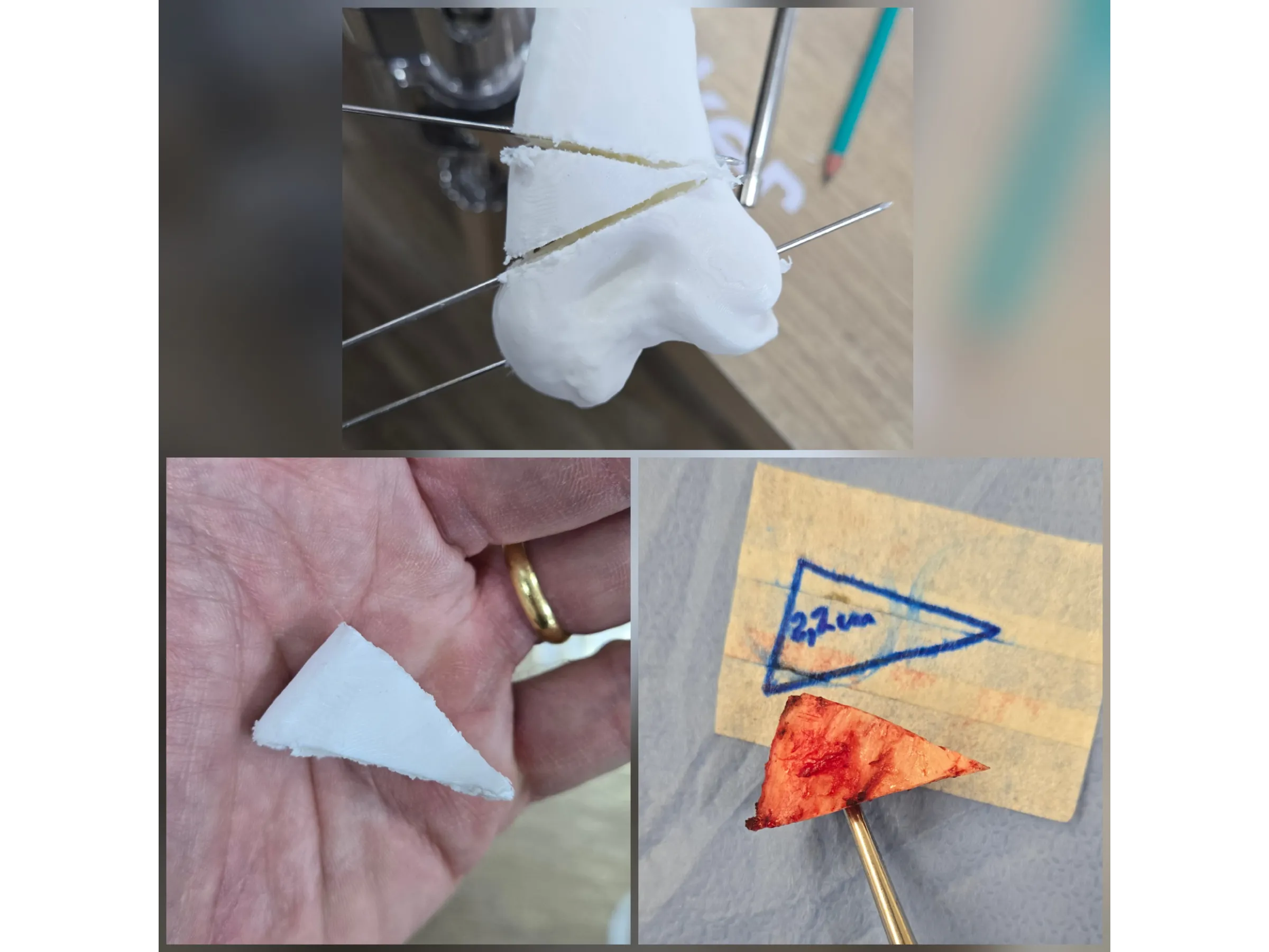 Osteotomia do Úmero Distal – Cúbito Varo