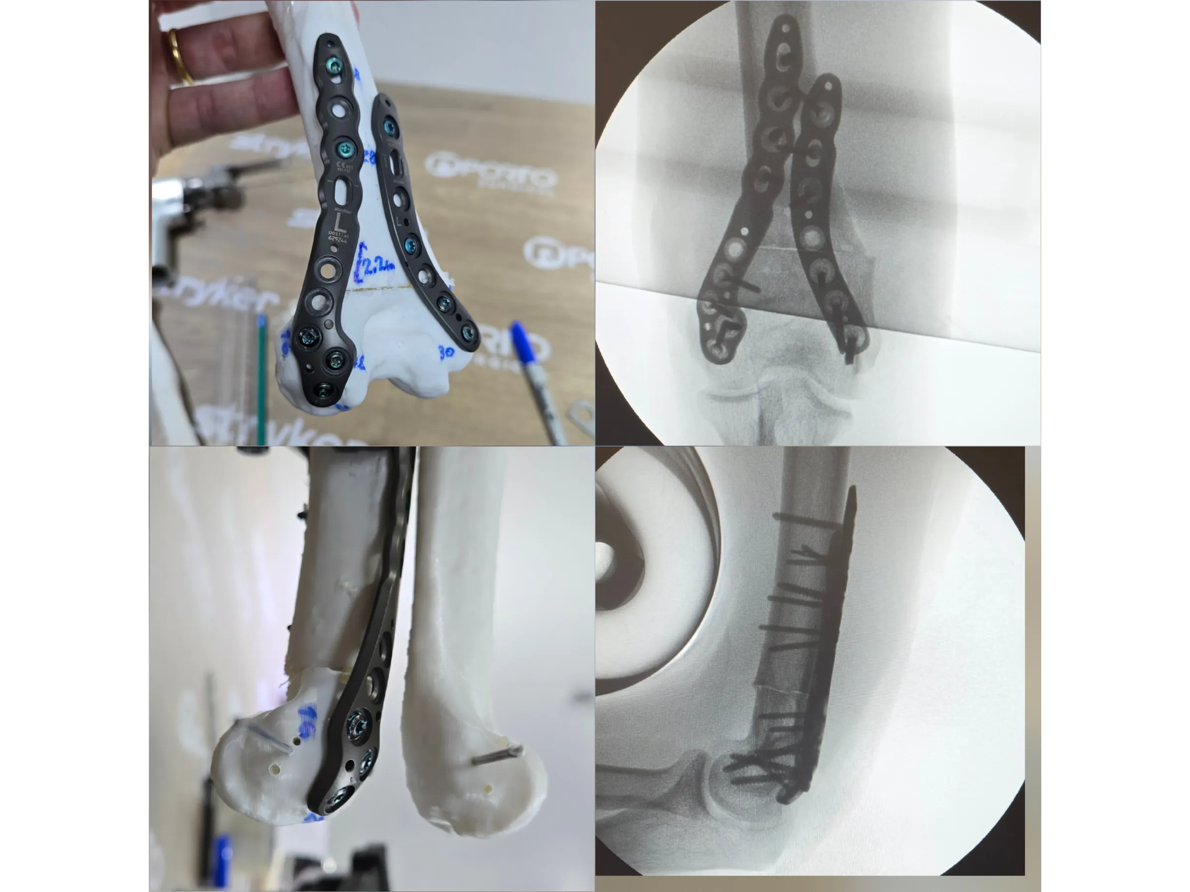 Osteotomia do Úmero Distal – Cúbito Varo