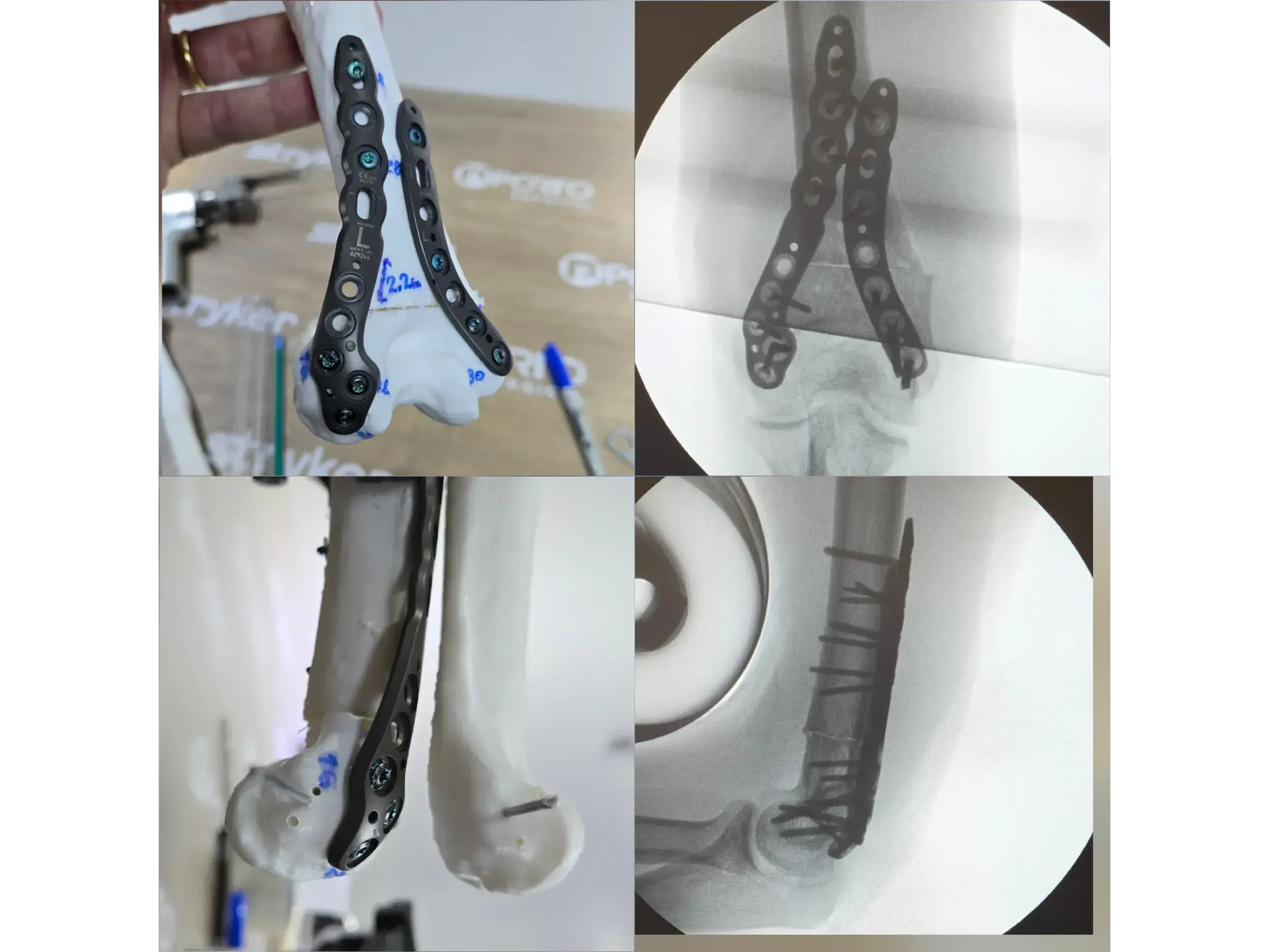 Osteotomia do Úmero Distal – Cúbito Varo
