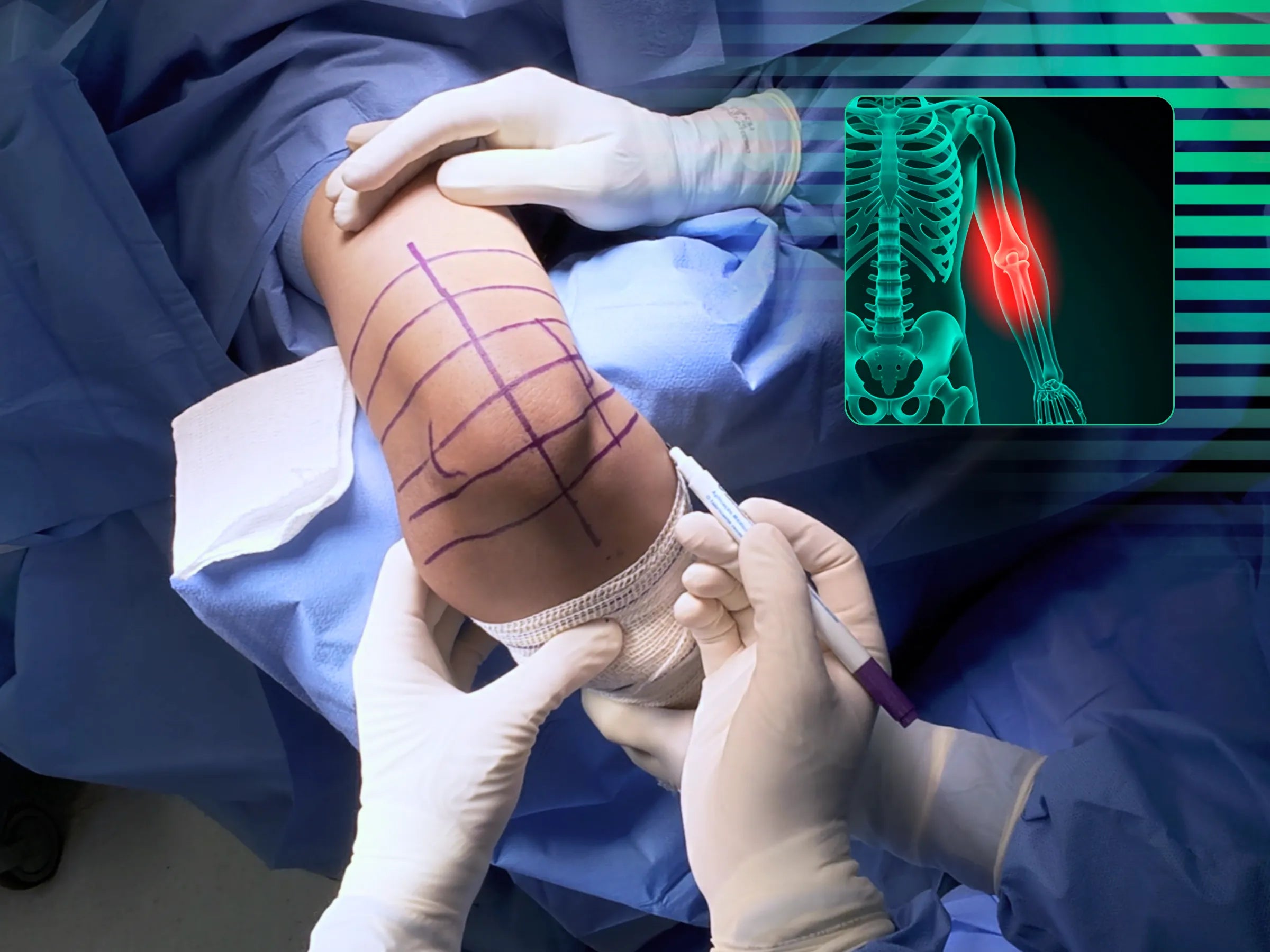 Osteotomia do Úmero Distal – Cúbito Varo