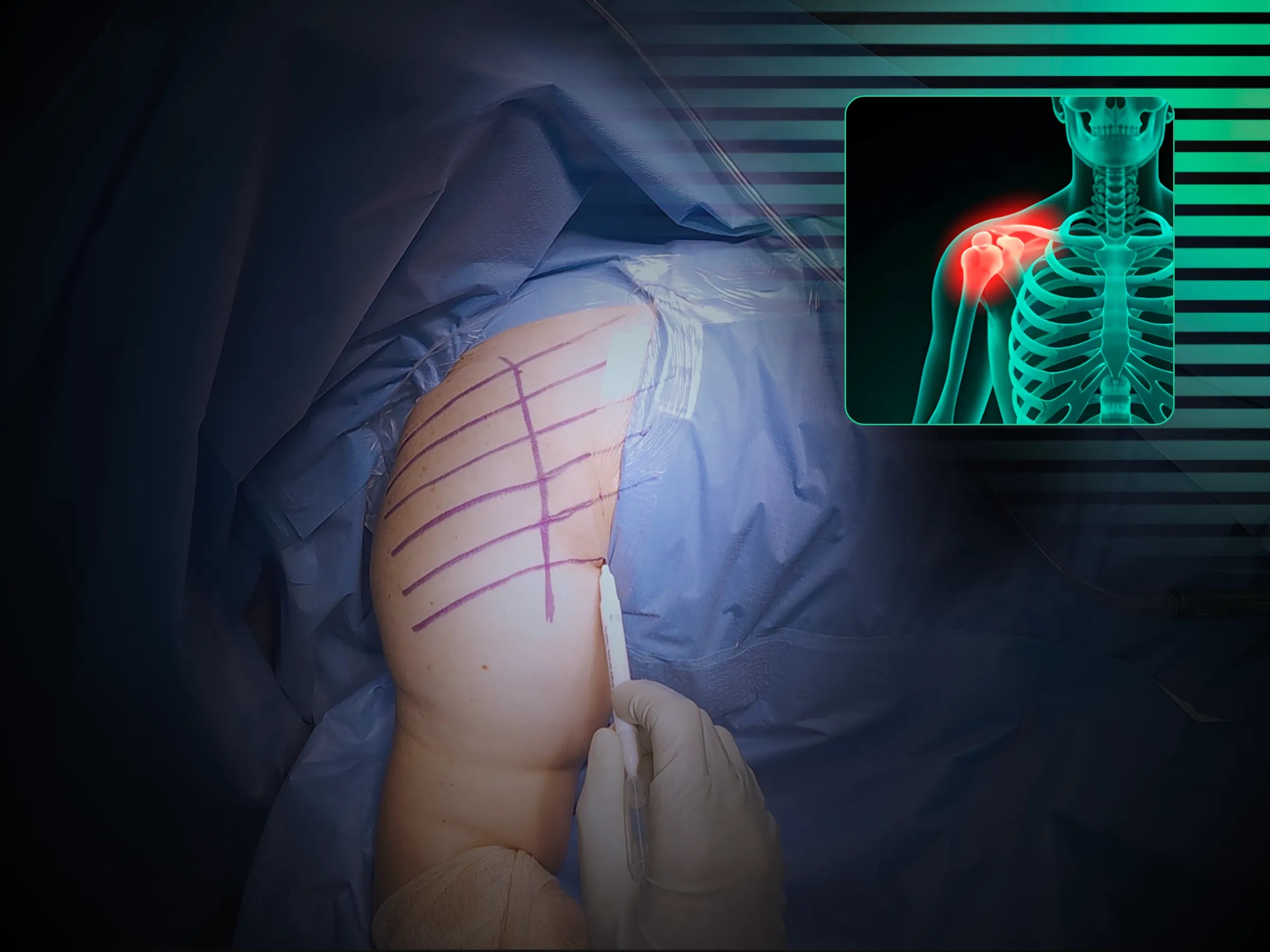 Úmero Proximal – Fratura em 4 Partes