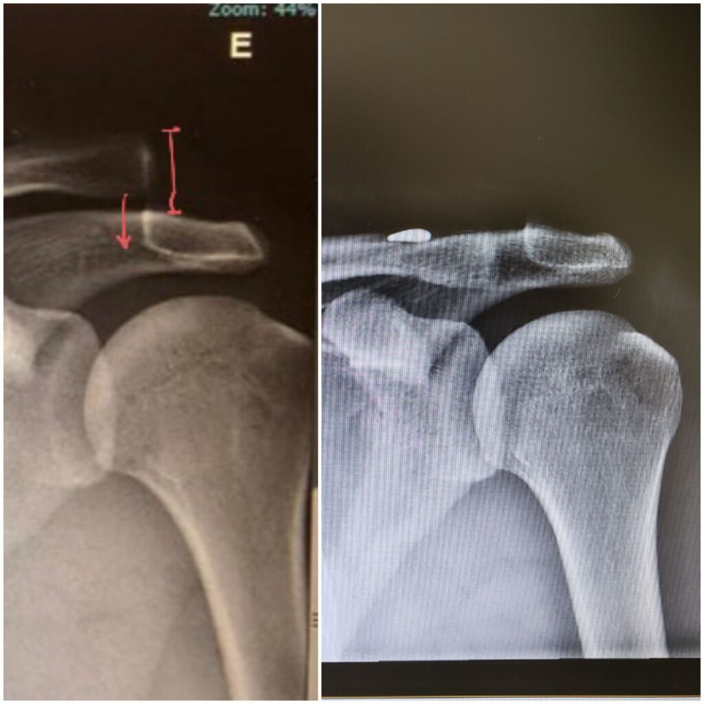 Luxa O Acr Mio Clavicular Dr S Vio Chami