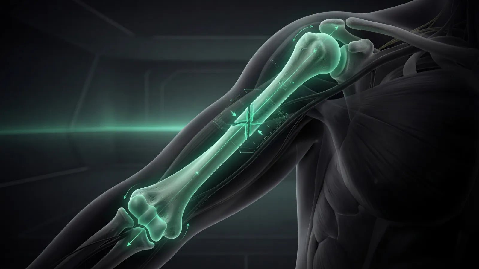 Fratura Diafisária do Úmero com Haste Intramedular