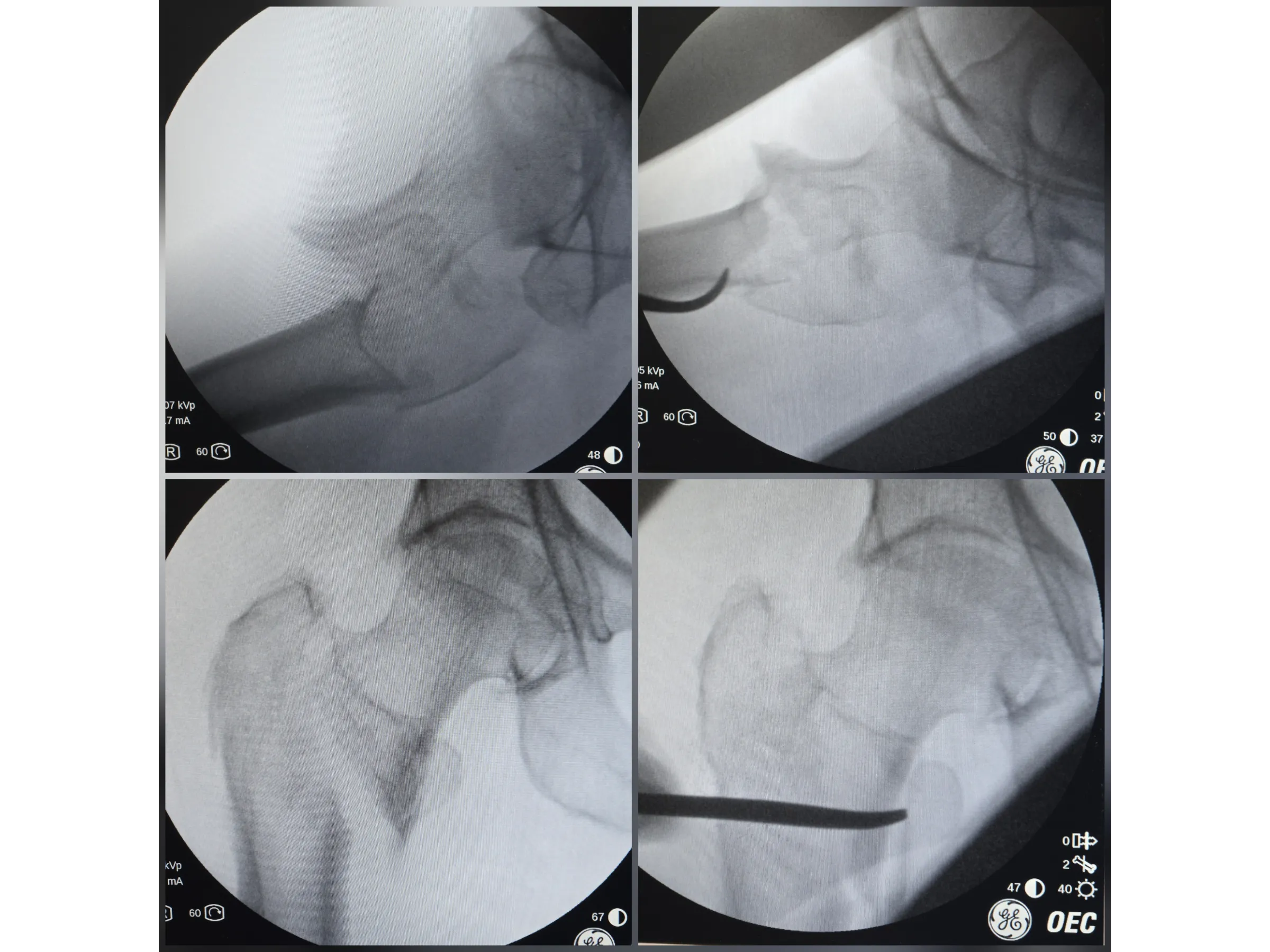 FÊMUR PROXIMAL [Caso 4] · Dupla Técnica da Gangorra