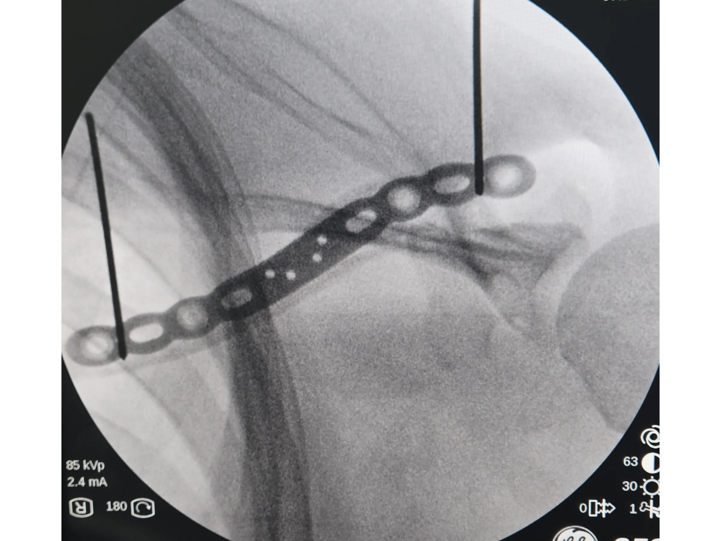 Fratura da Clavícula 02 - Técnica Minimamente Invasiva