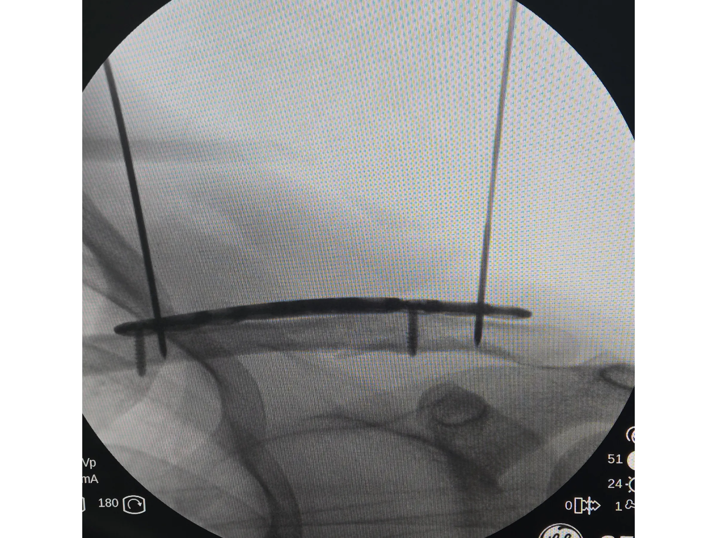 Fratura da Clavícula 02 - Técnica Minimamente Invasiva