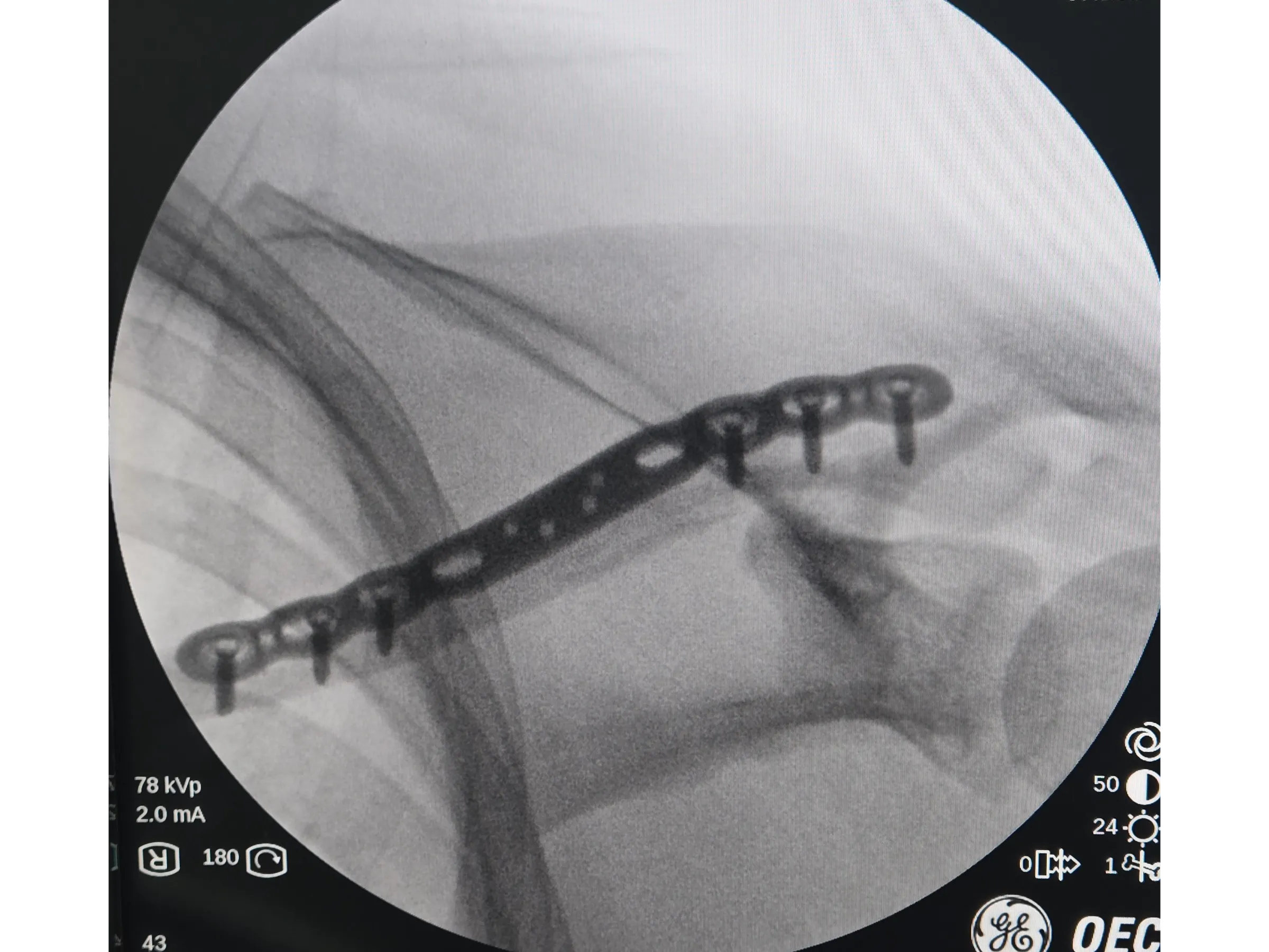 Fratura da Clavícula 02 - Técnica Minimamente Invasiva