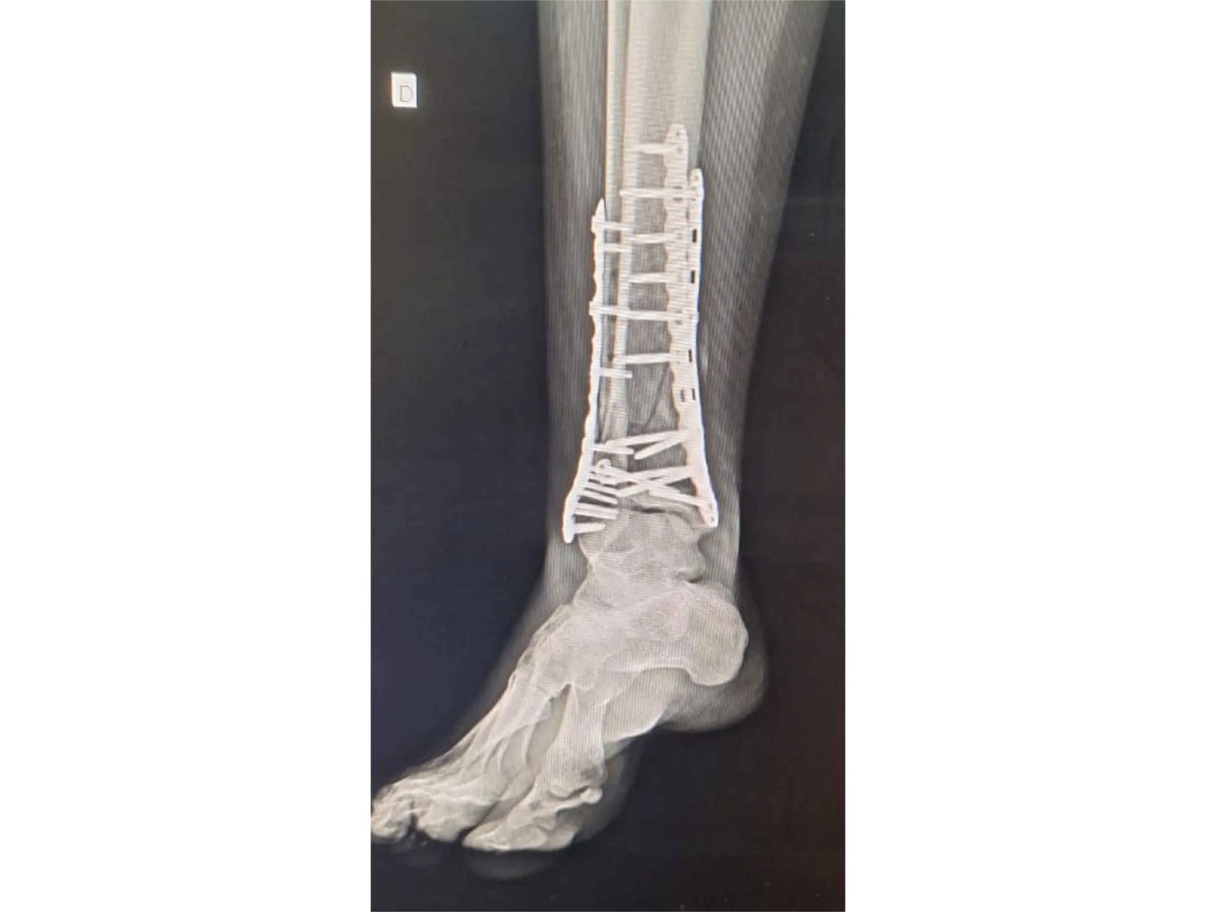PILÃO TIBIAL [Caso 2] · Abordagem Póstero-Medial + Lateral