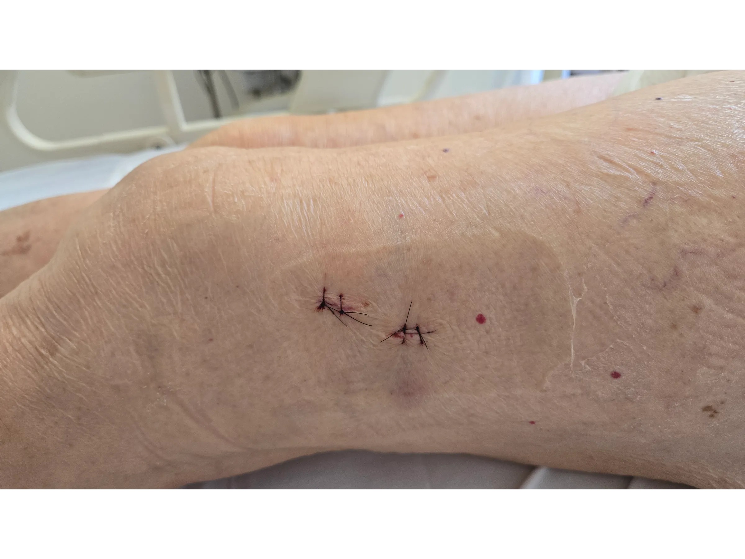 FRATURA SUBTROCANTERIANA [Caso 1] · Haste Intramedular Minimamente Invasiva