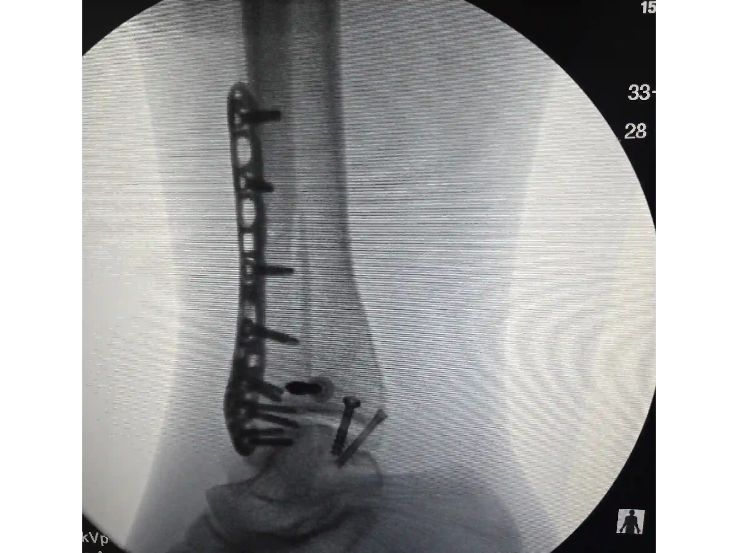 TRIMALEOLAR [CASO 03] Abordagem posterolateral + fixação anterógrada do maléolo medial