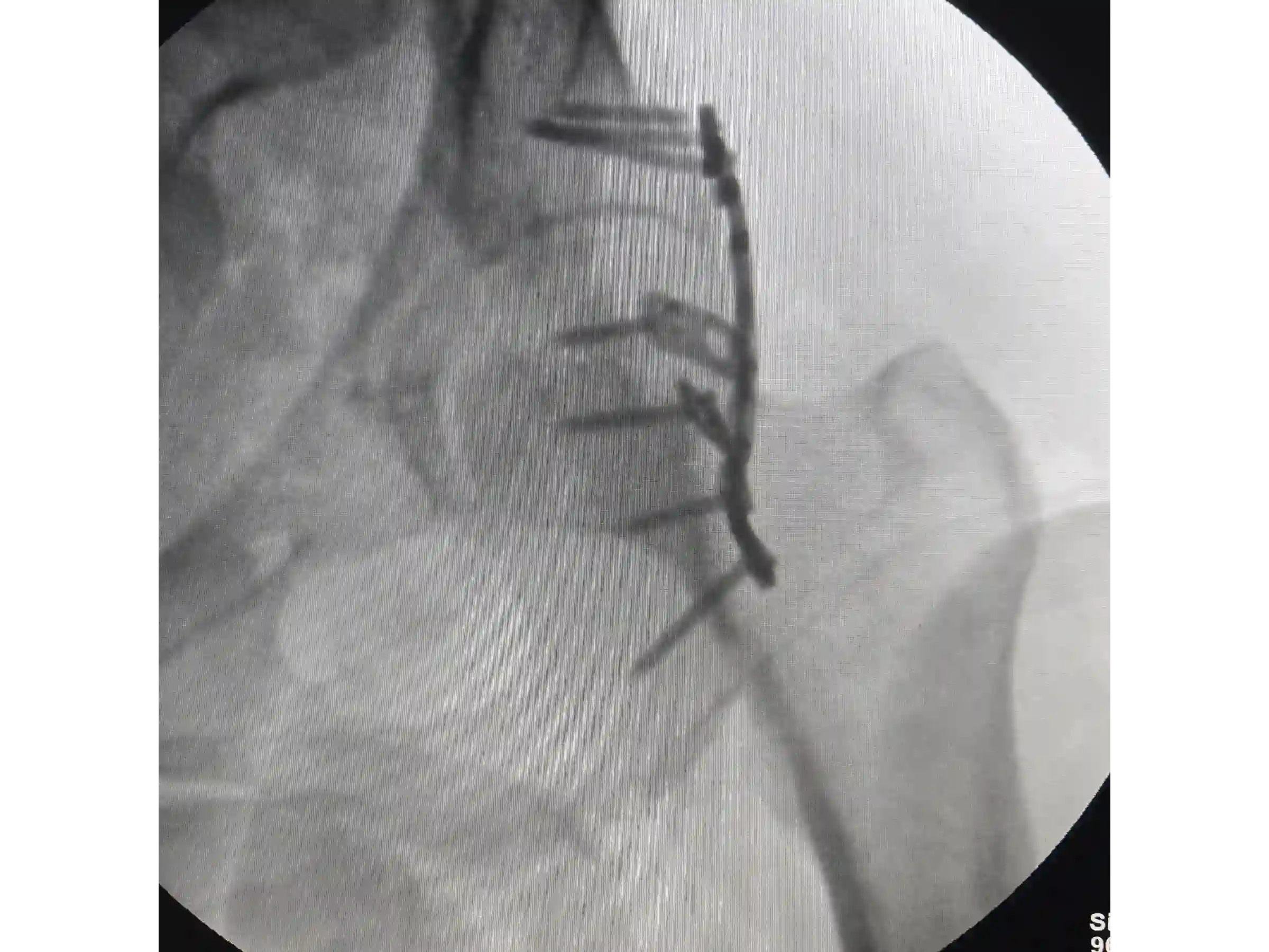 ACETÁBULO [CASO 02] · Rebordo Posterior + Impacção Articular