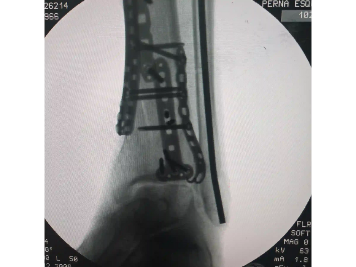 PILÃO TIBIAL [CASO 03] Abordagem Anterolateral e Posteromedial