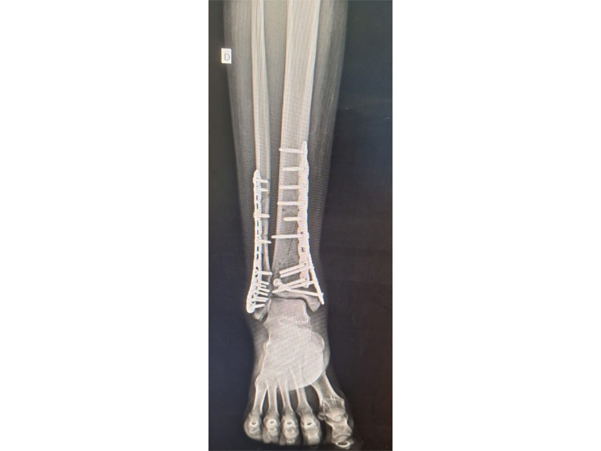 PILÃO TIBIAL [Caso 2] · Abordagem Póstero-Medial + Lateral