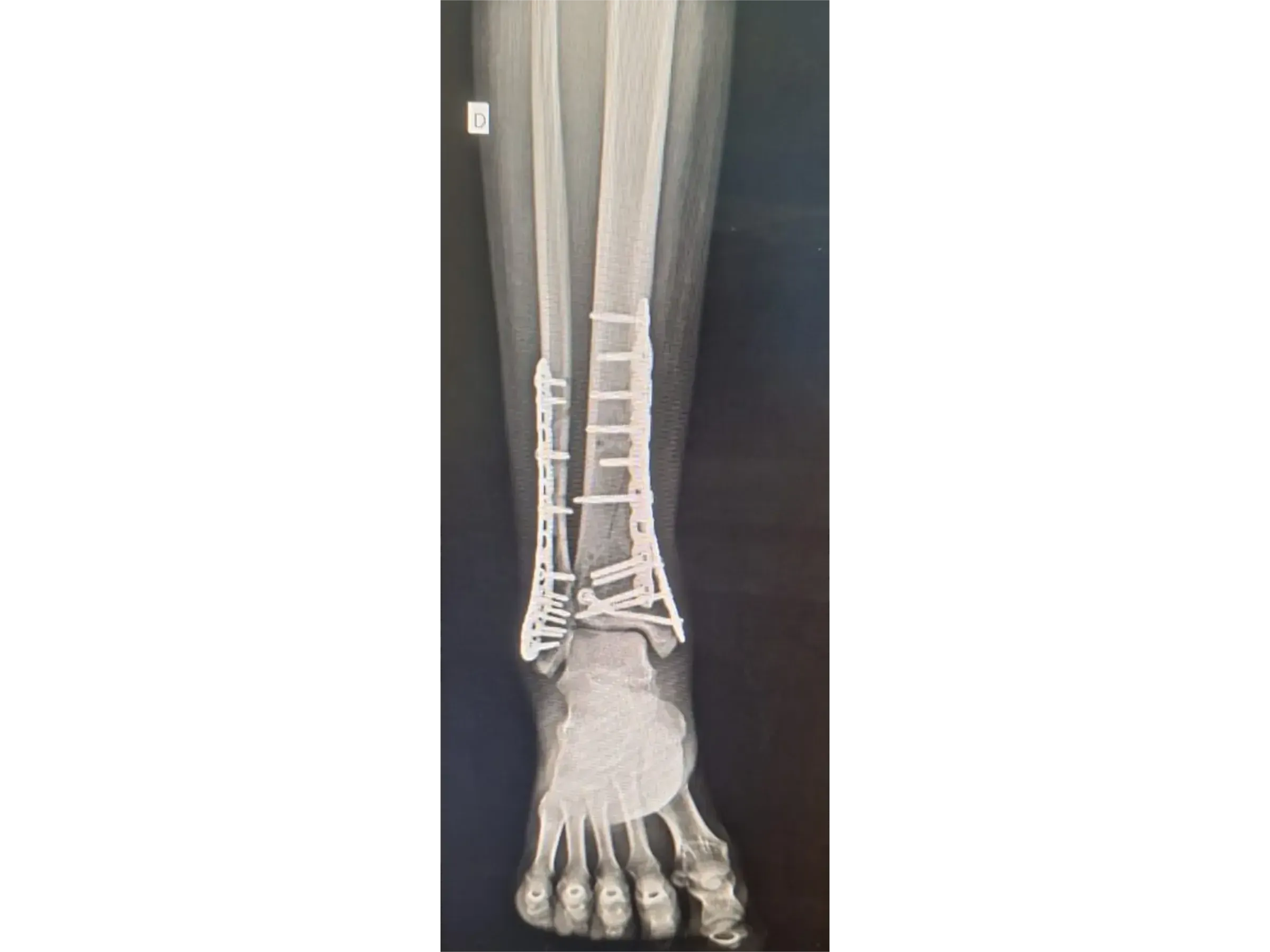 PILÃO TIBIAL [Caso 2] · Abordagem Póstero-Medial + Lateral