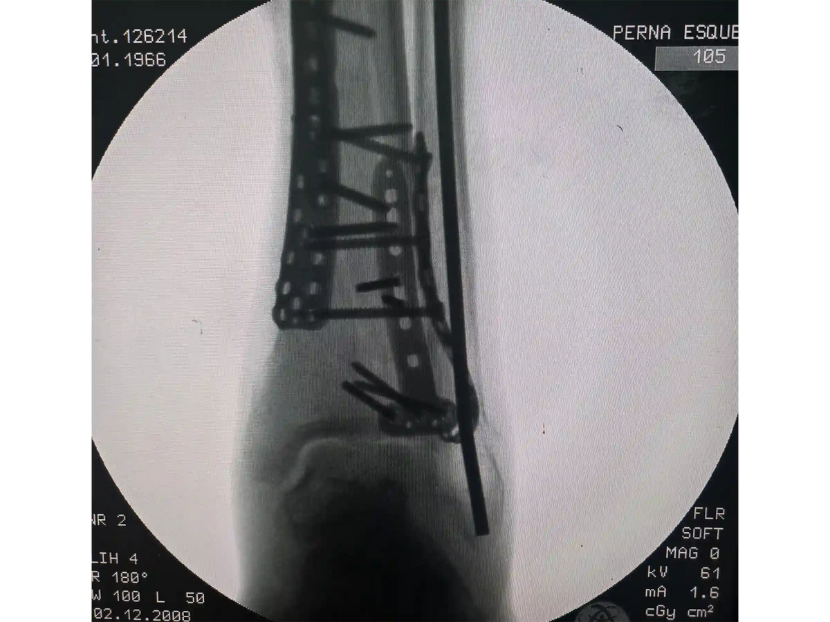 PILÃO TIBIAL [CASO 03] Abordagem Anterolateral e Posteromedial