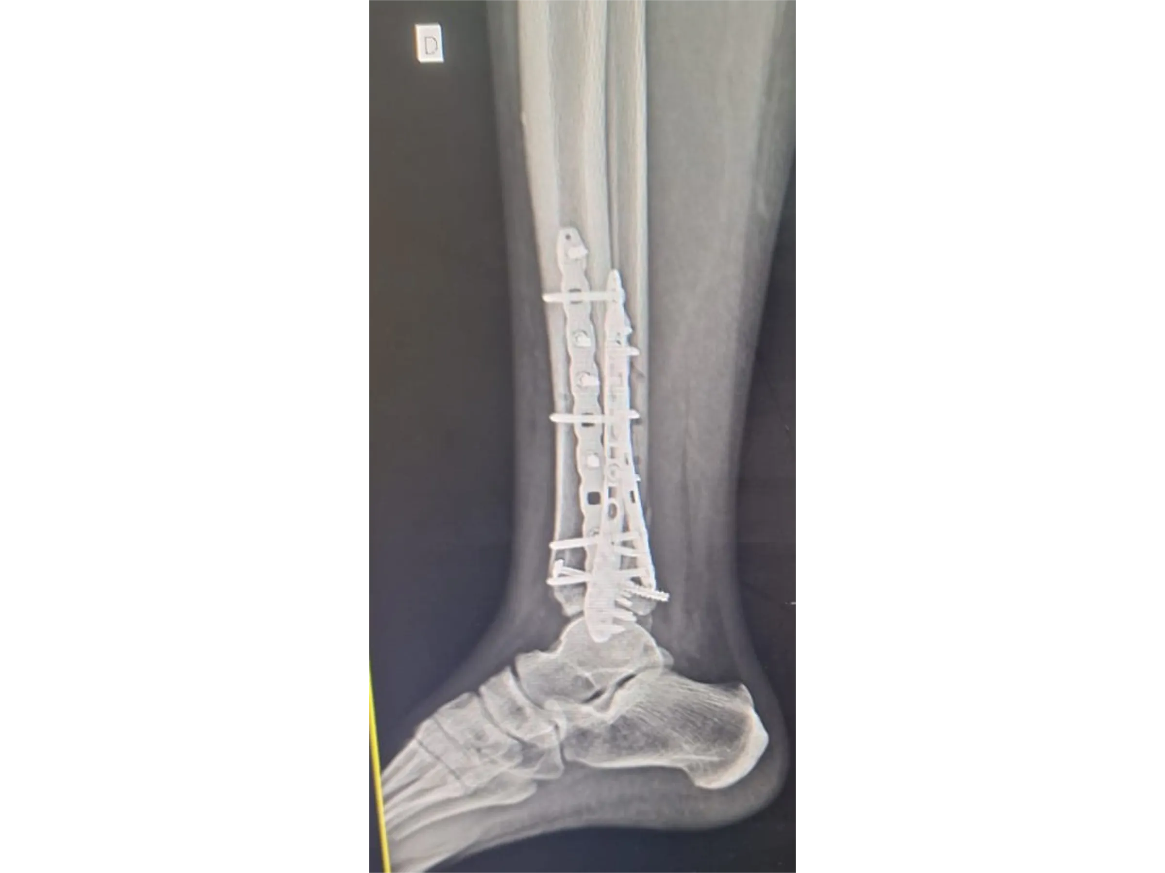 PILÃO TIBIAL [Caso 2] · Abordagem Póstero-Medial + Lateral