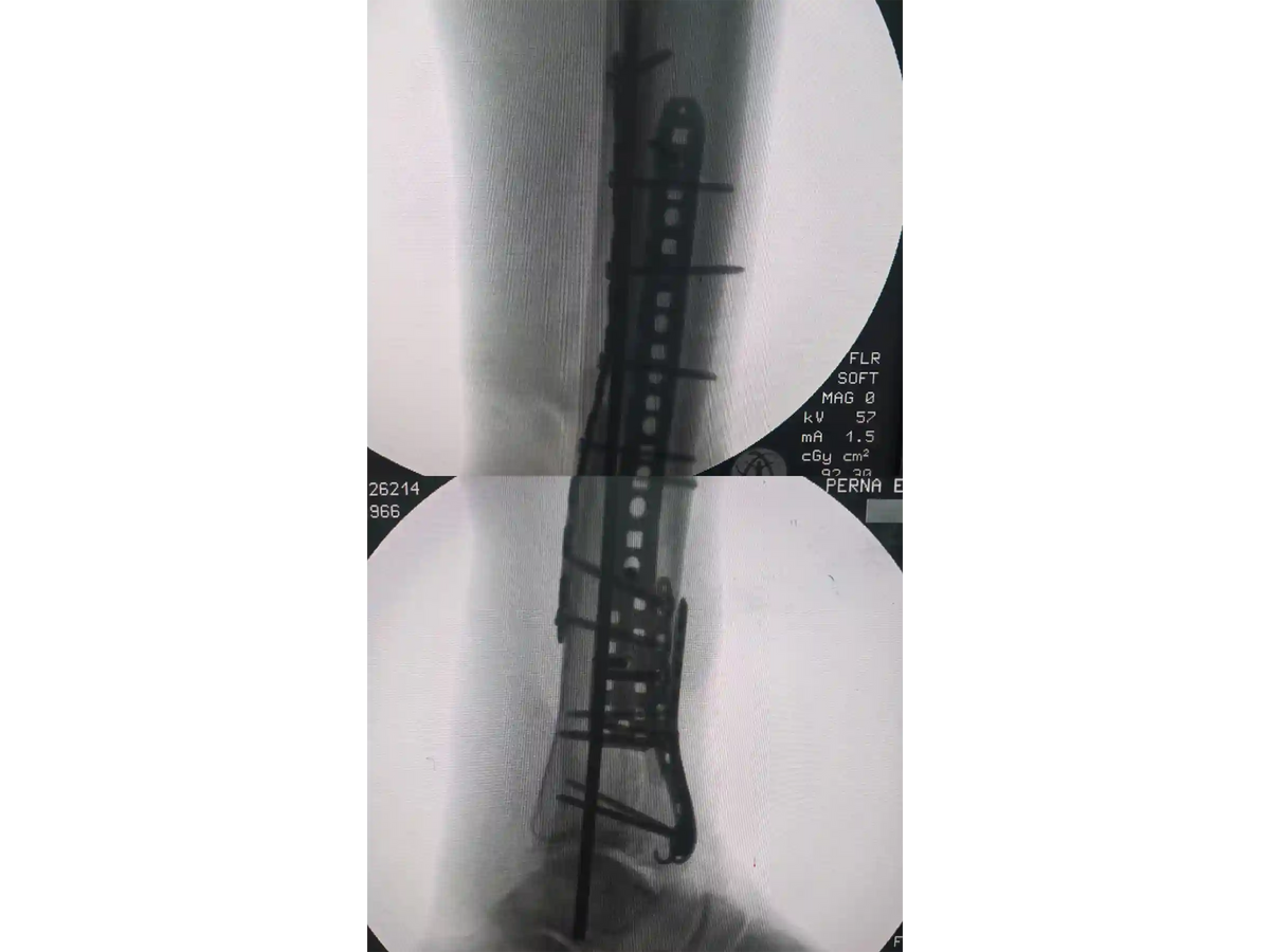 PILÃO TIBIAL [CASO 03] Abordagem Anterolateral e Posteromedial