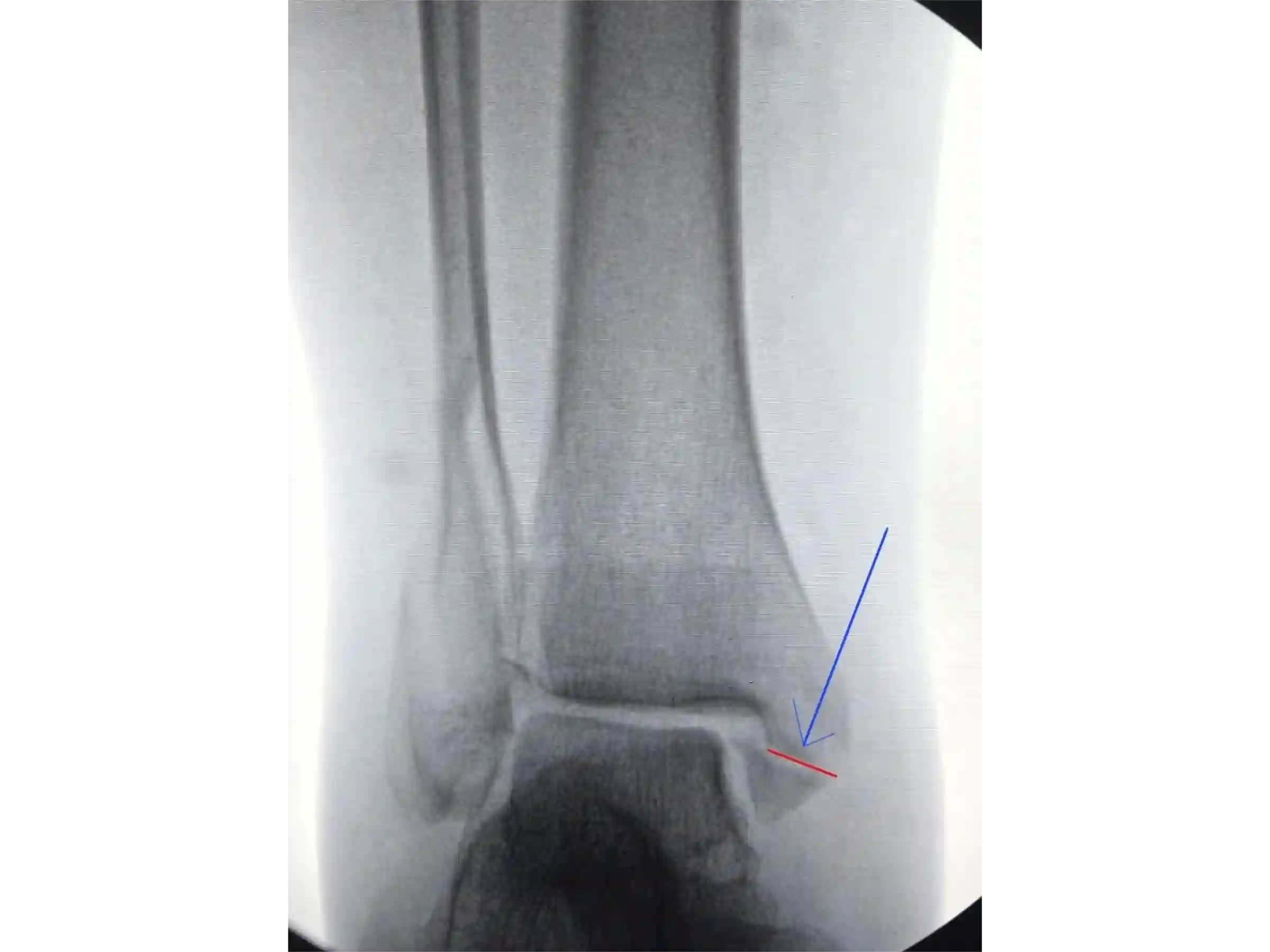 TRIMALEOLAR [CASO 03] Abordagem posterolateral + fixação anterógrada do maléolo medial