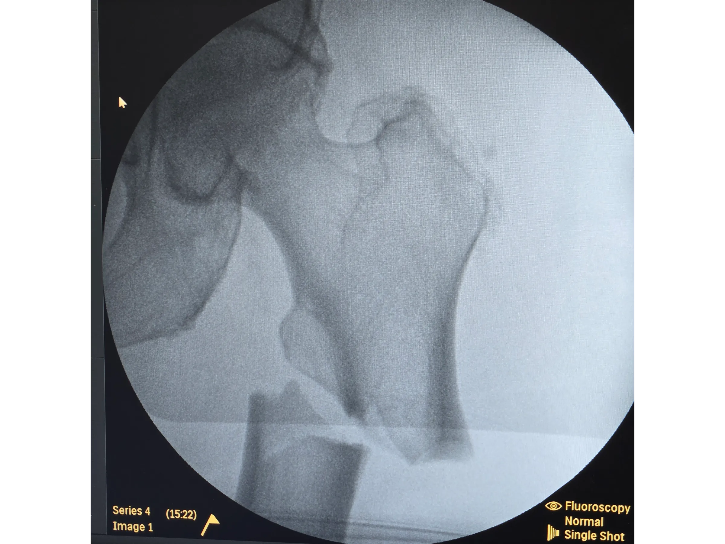 FRATURA SUBTROCANTERIANA [Caso 1] · Haste Intramedular Minimamente Invasiva