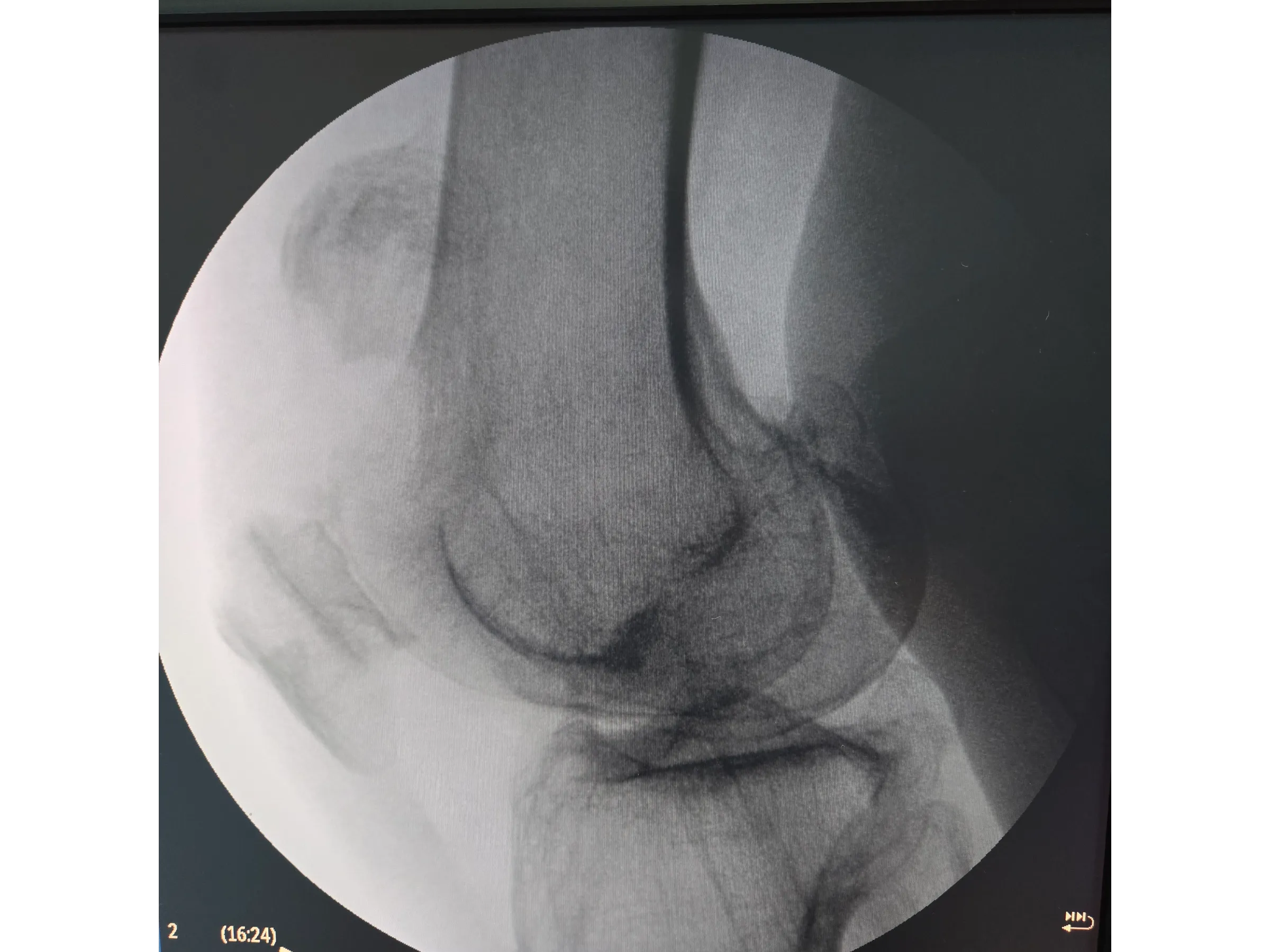 PATELA [Caso 2] · Parafusos Canulados + Cerclagem
