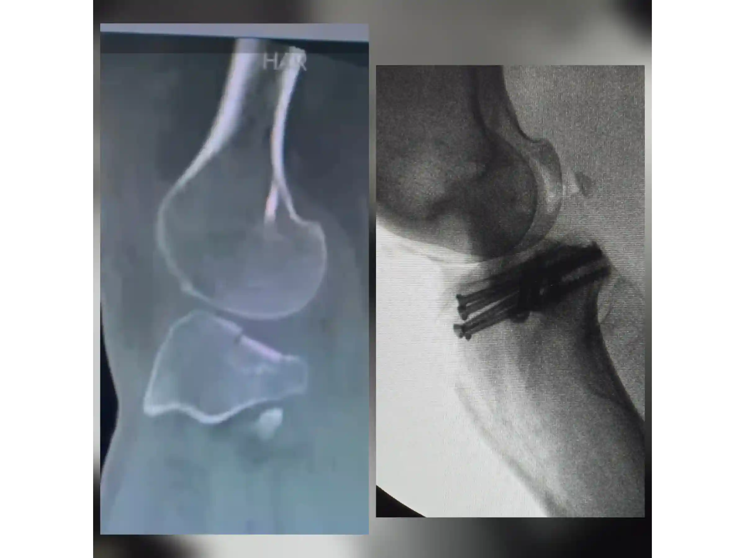 PLANALTO TIBIAL [CASO 03] Jail Technique Afundamento Posterolateral