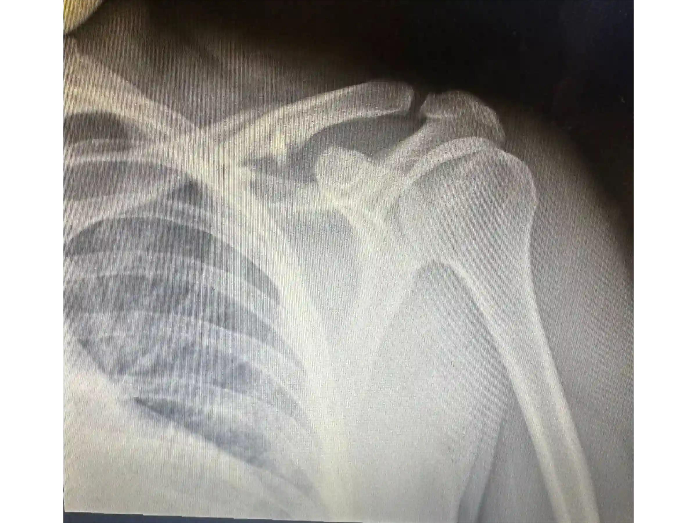 CLAVICLE [CASE 03] - Minimally Invasive Percutaneous Osteosynthesis