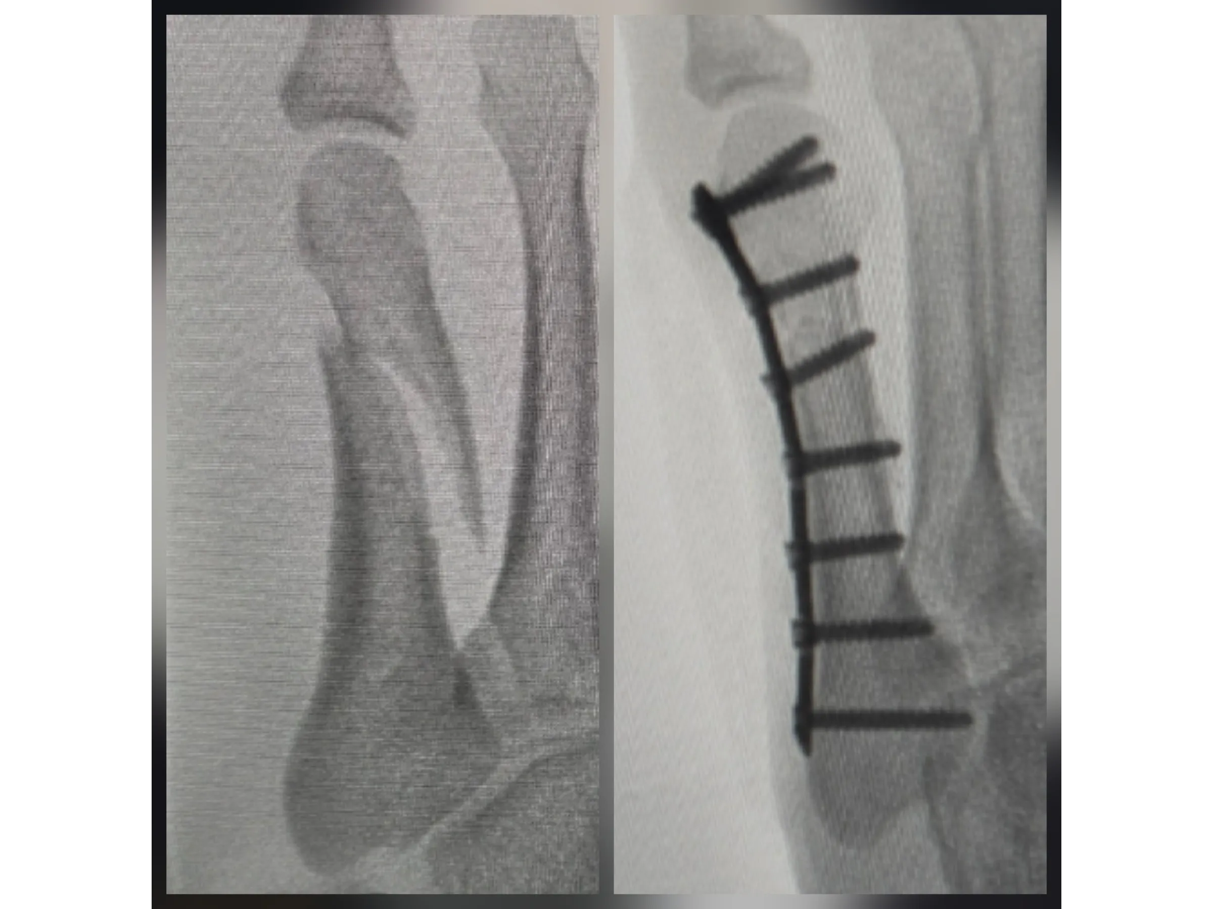 QUINTO METATARSO [Caso 2] · Placa e Parafusos de Minifragmentos