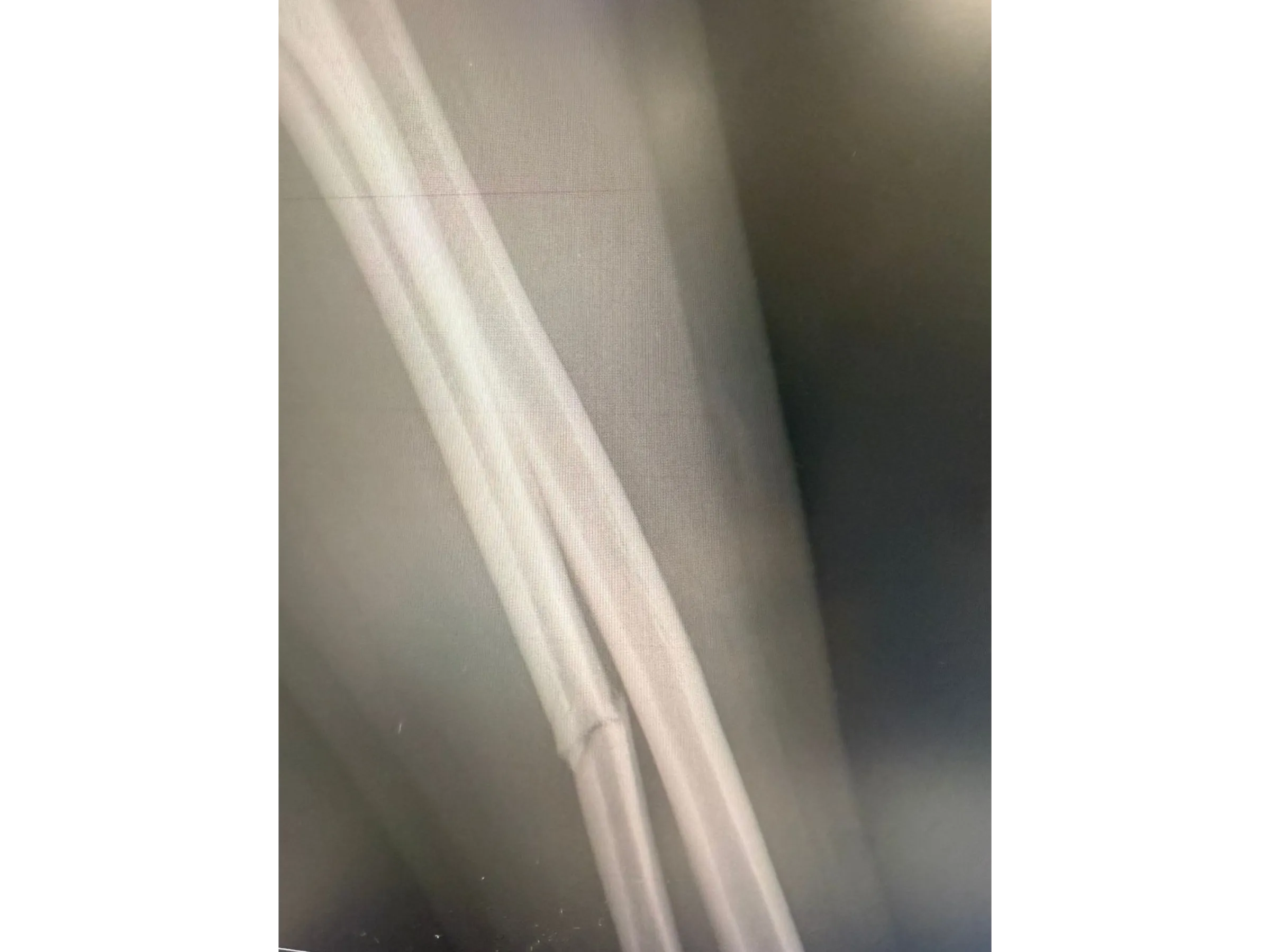 DIÁFISE DA ULNA [Caso 2] · Placa e Parafusos