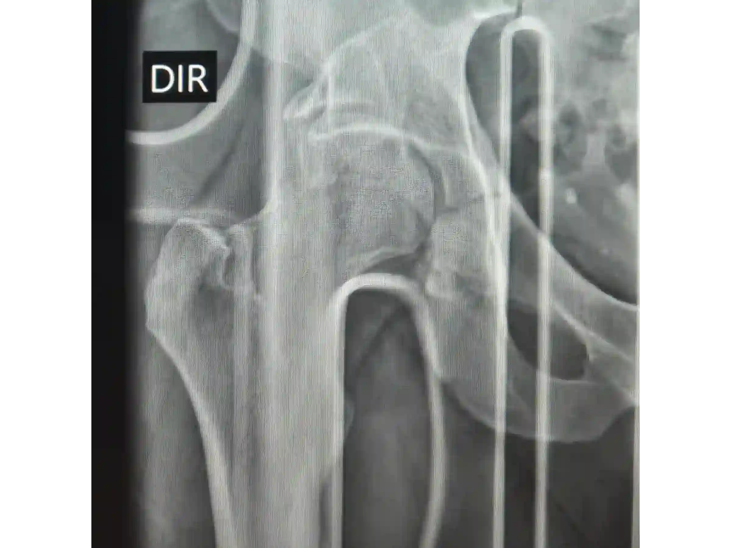 ACETÁBULO [CASO 02] · Rebordo Posterior + Impacção Articular