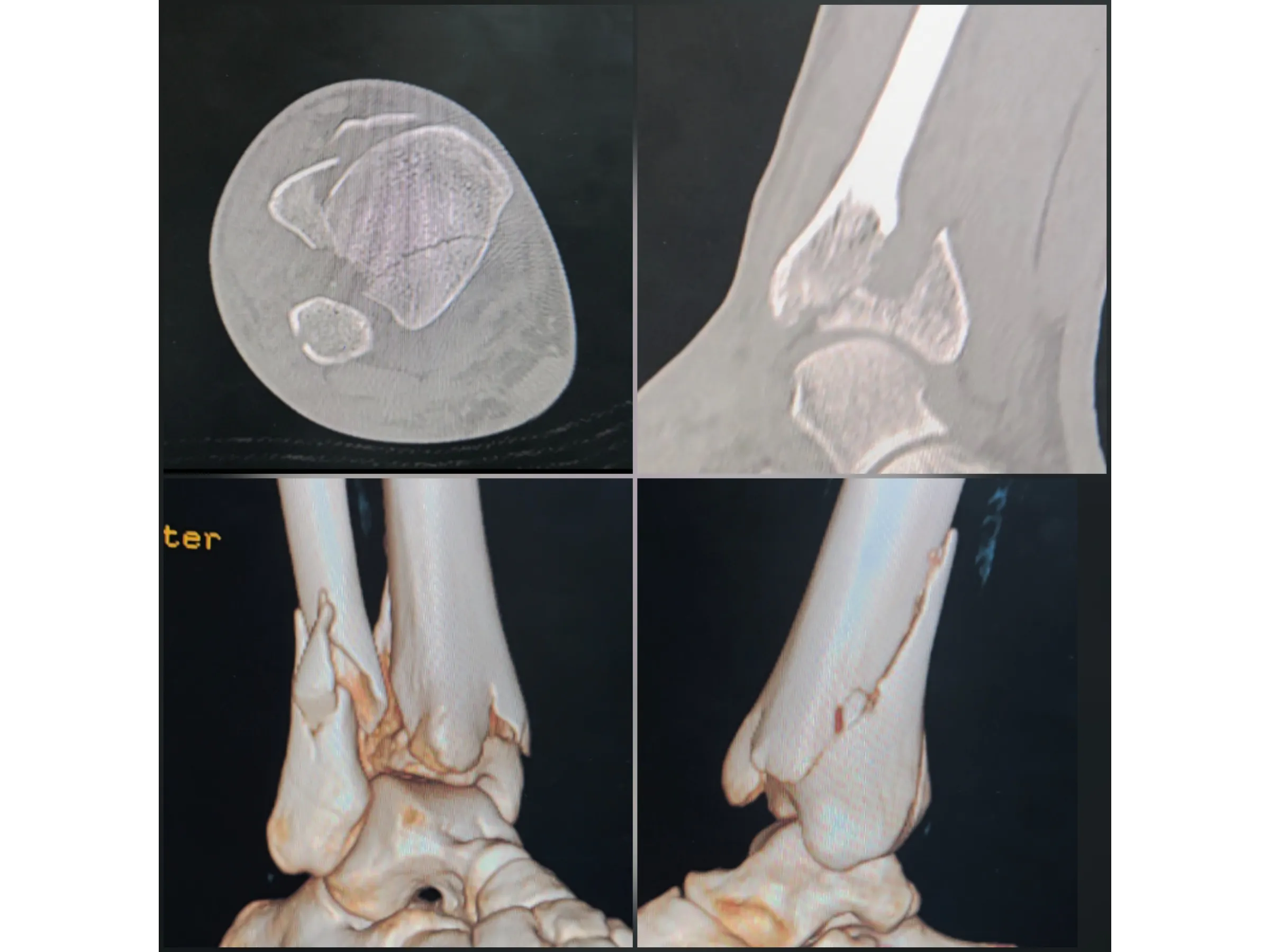 PILÃO TIBIAL [Caso 2] · Abordagem Póstero-Medial + Lateral