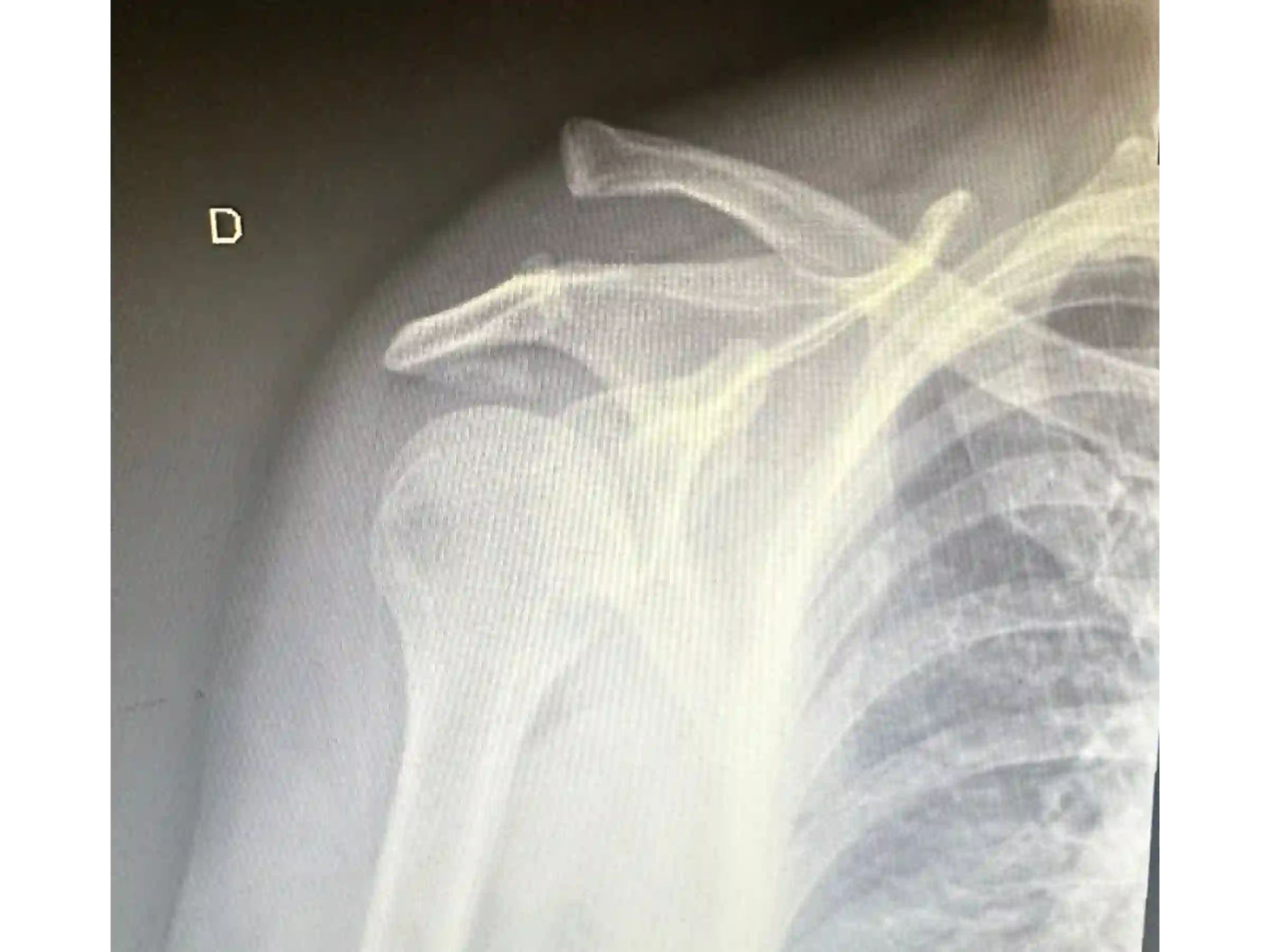 ACROMIOCLAVICULAR [CASO 3] Fixação com TightRope