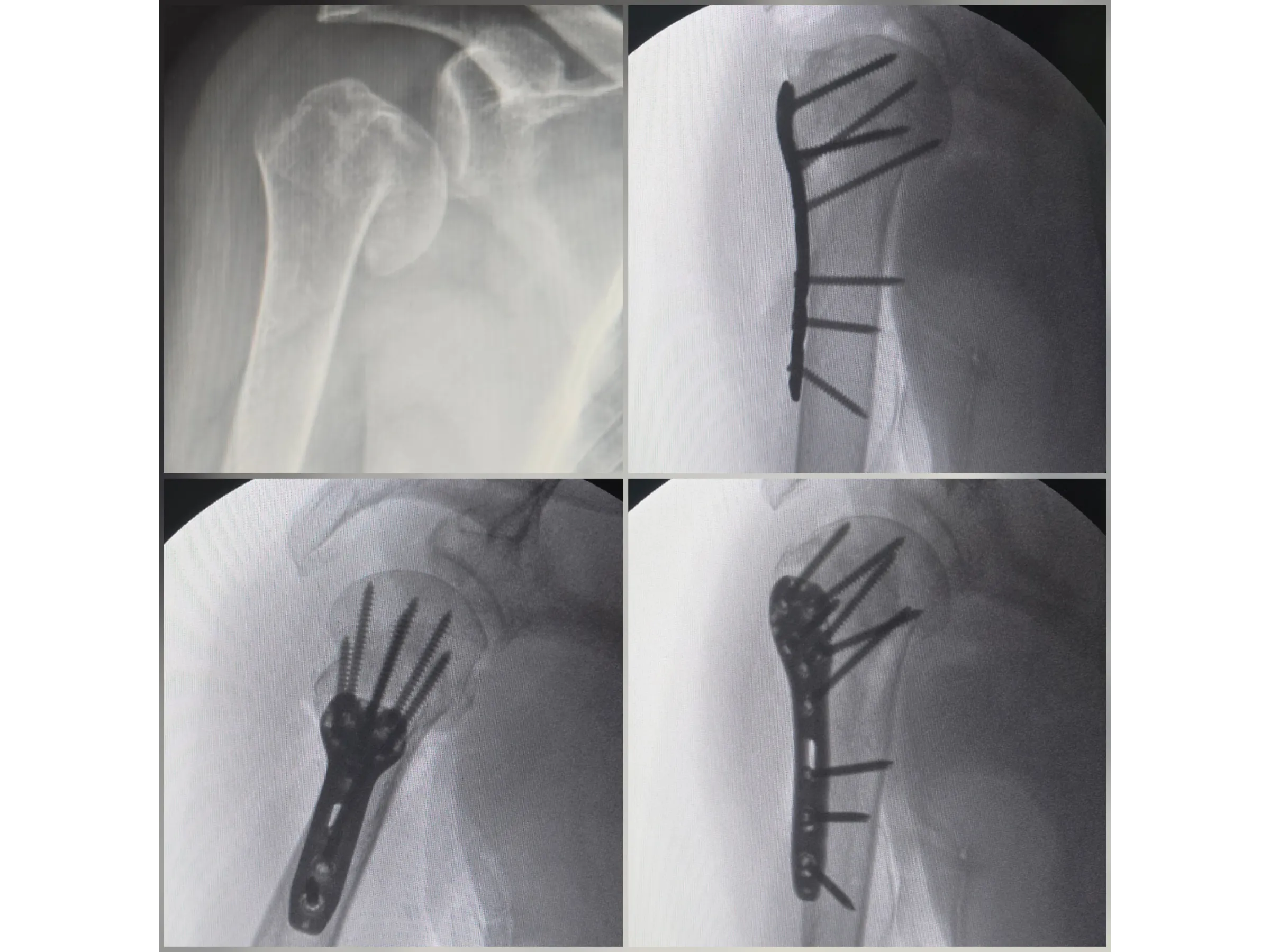 ÚMERO PROXIMAL [Caso 6] · Duas Partes · Placa e Parafusos