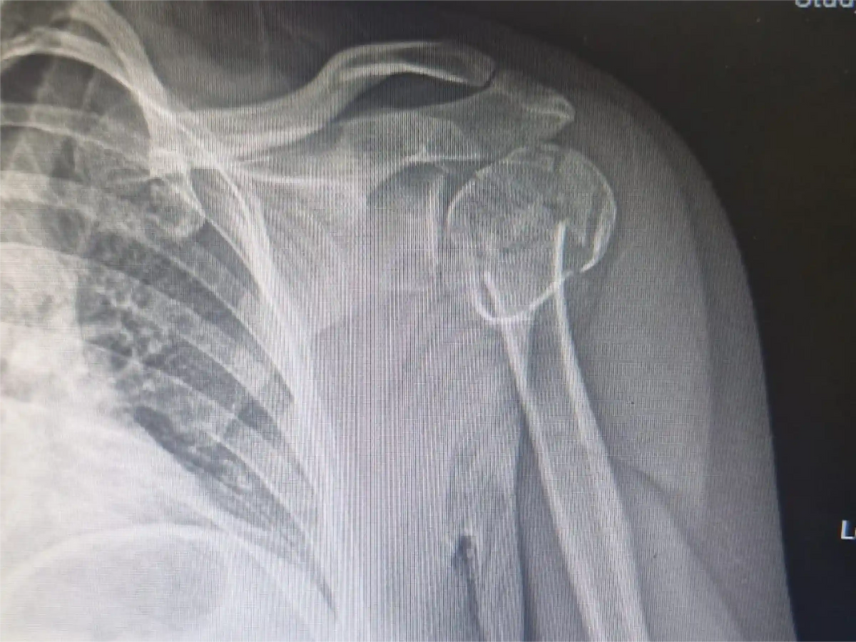 ÚMERO PROXIMAL [CASO 07] - Head-Split Em Paciente Jovem Placa E Parafusos