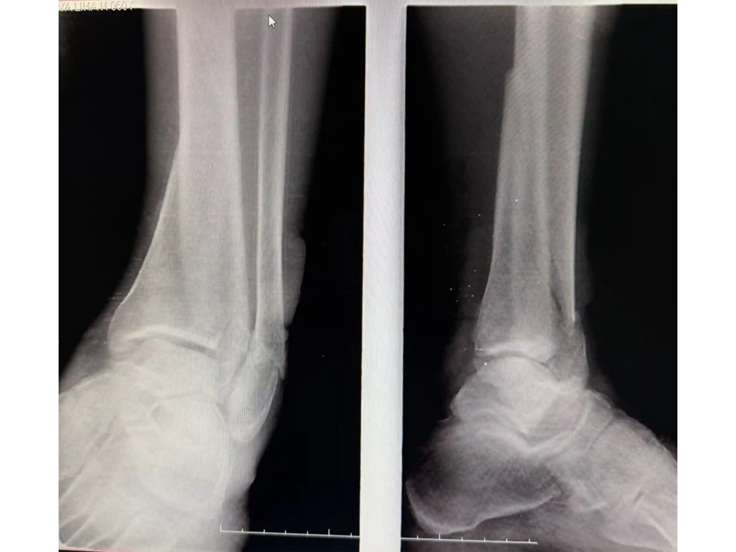 PILÃO TIBIAL [CASO 03] Abordagem Anterolateral e Posteromedial