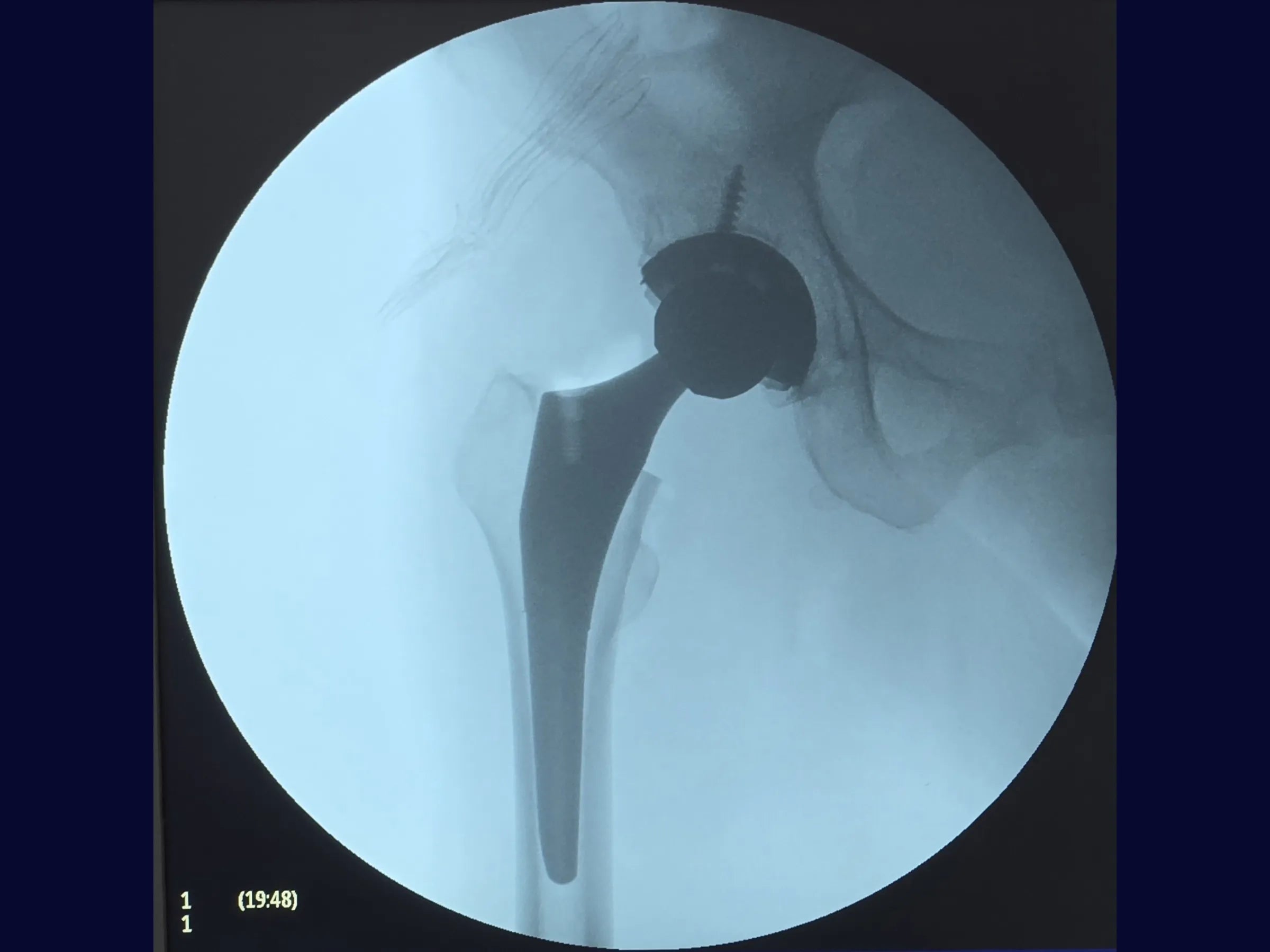 Artroplastia Total Do Quadril - Abordagem Posterior