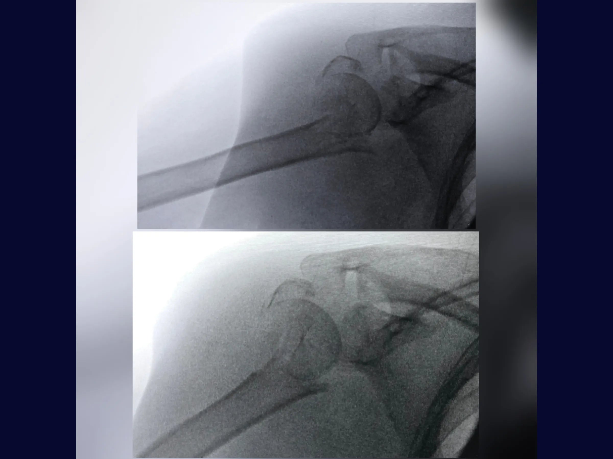 Úmero Proximal – Fratura em 4 Partes