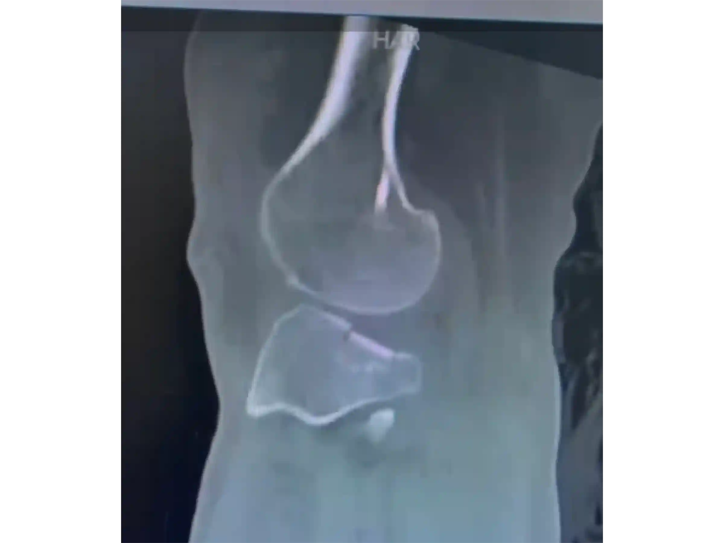 PLANALTO TIBIAL [CASO 03] Jail Technique Afundamento Posterolateral