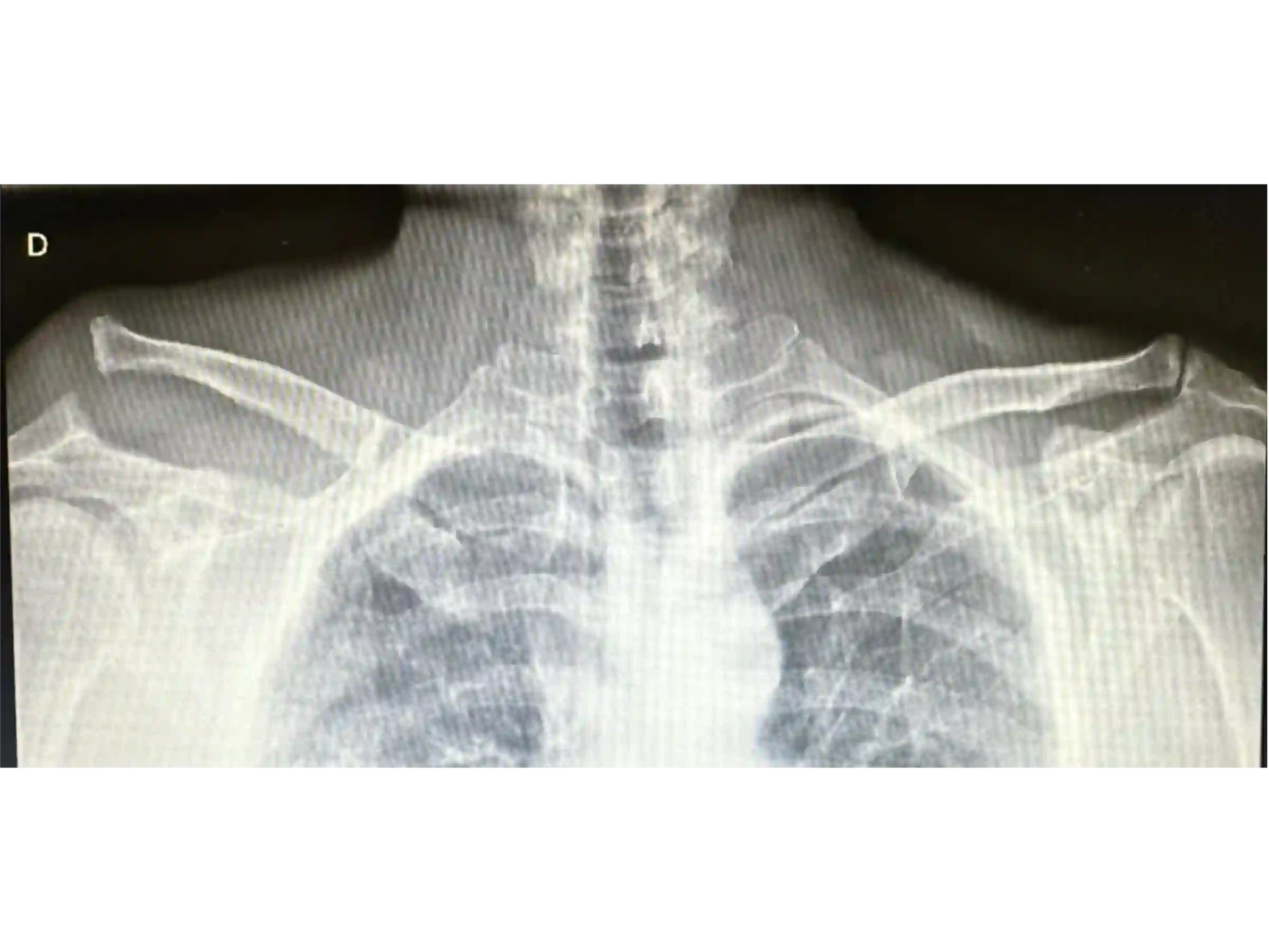 ACROMIOCLAVICULAR [CASO 3] Fixação com TightRope