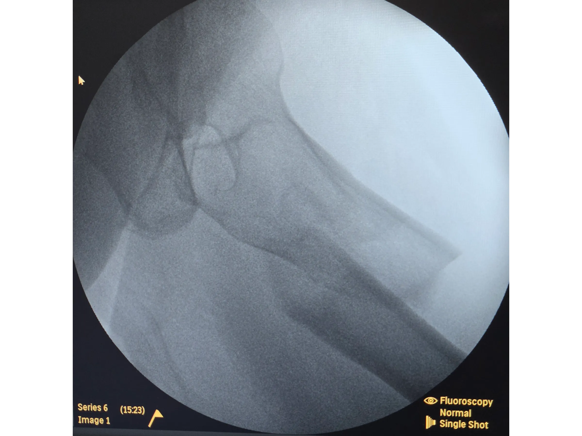 FRATURA SUBTROCANTERIANA [Caso 1] · Haste Intramedular Minimamente Invasiva