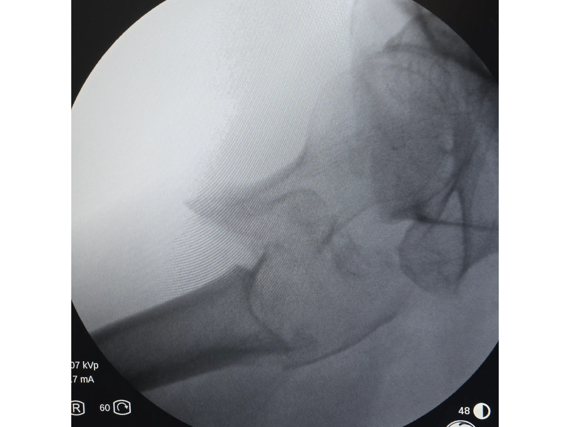 FÊMUR PROXIMAL [Caso 4] · Dupla Técnica da Gangorra