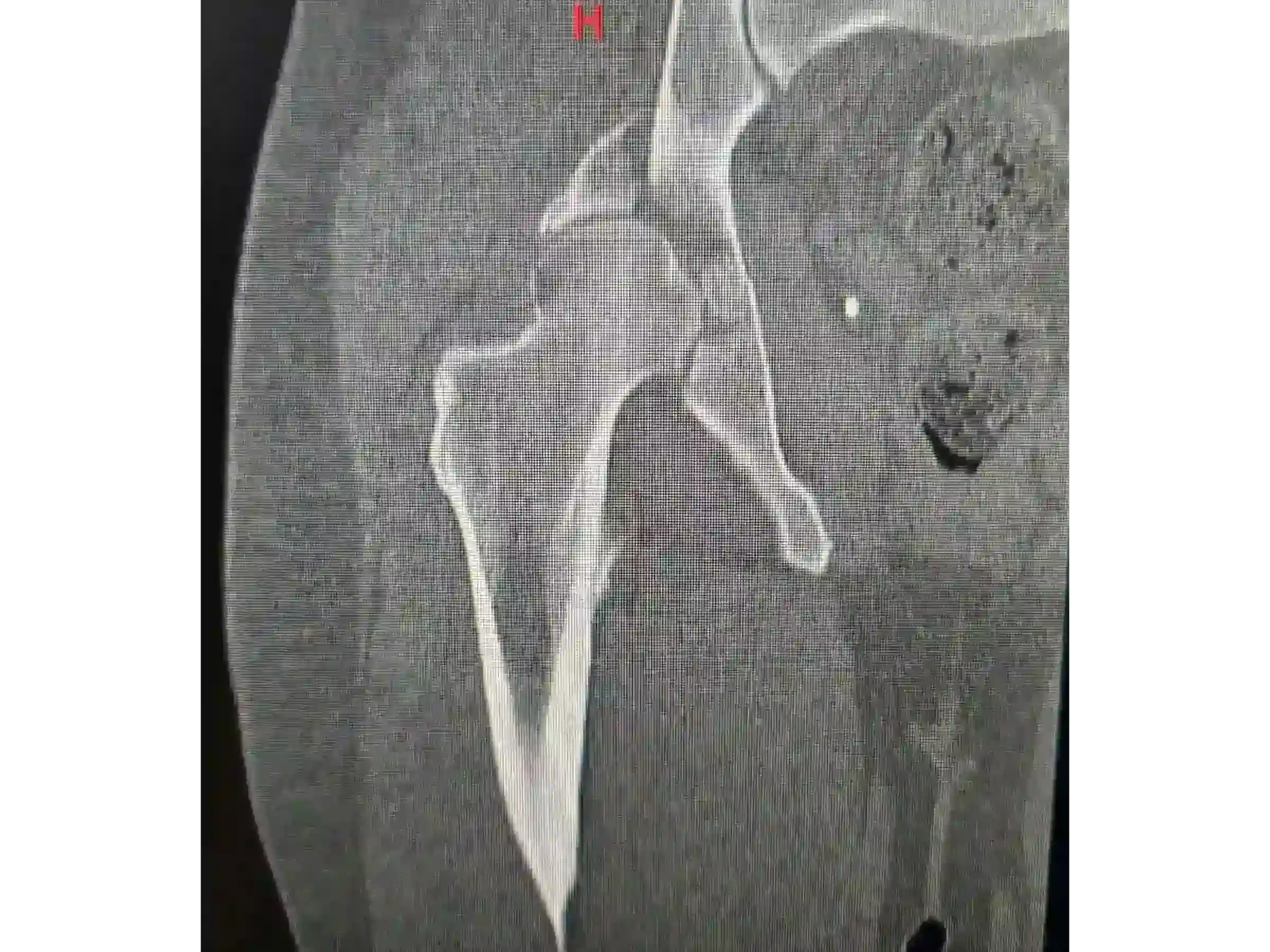 ACETÁBULO [CASO 02] · Rebordo Posterior + Impacção Articular