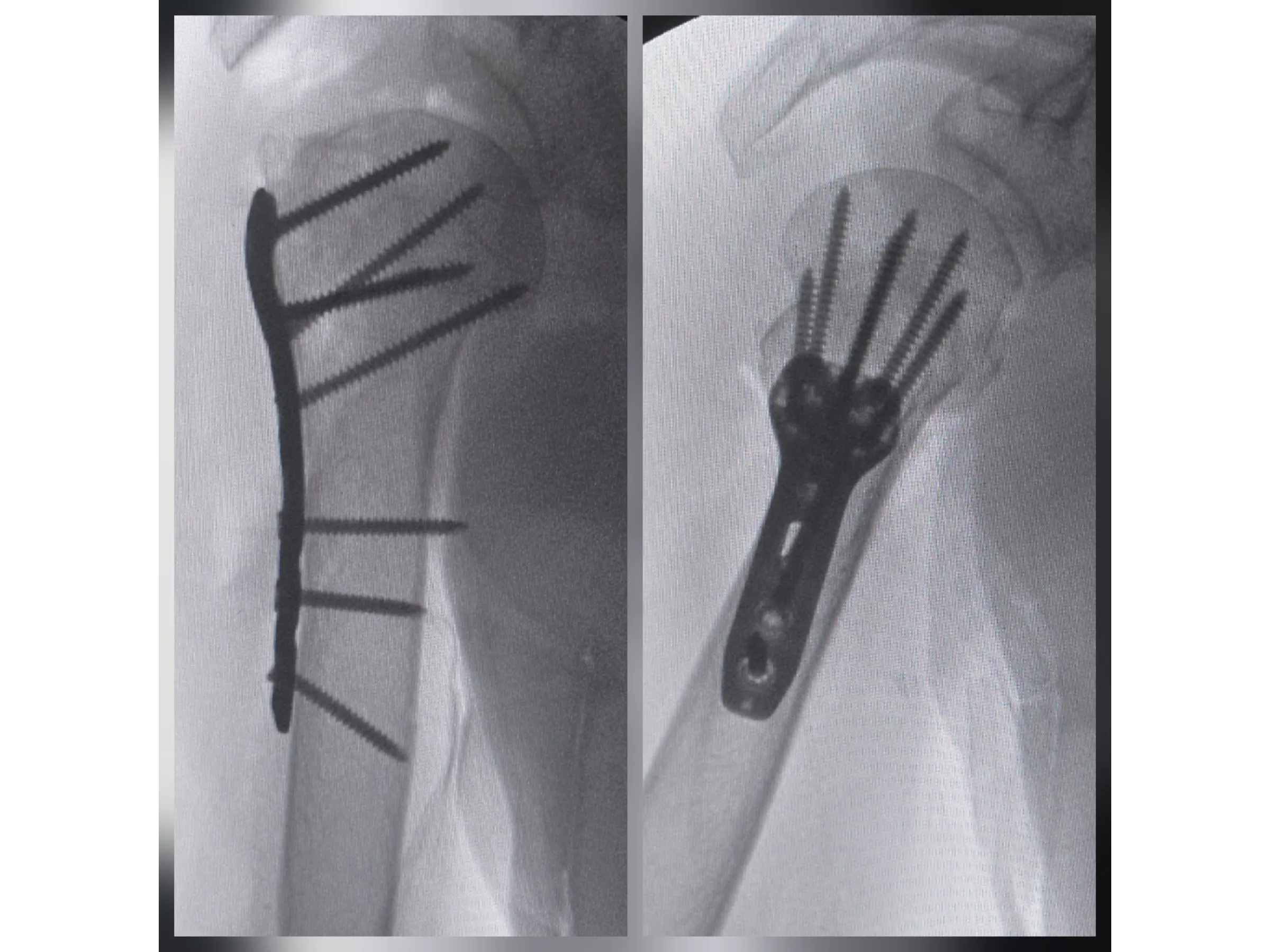 ÚMERO PROXIMAL [Caso 6] · Duas Partes · Placa e Parafusos