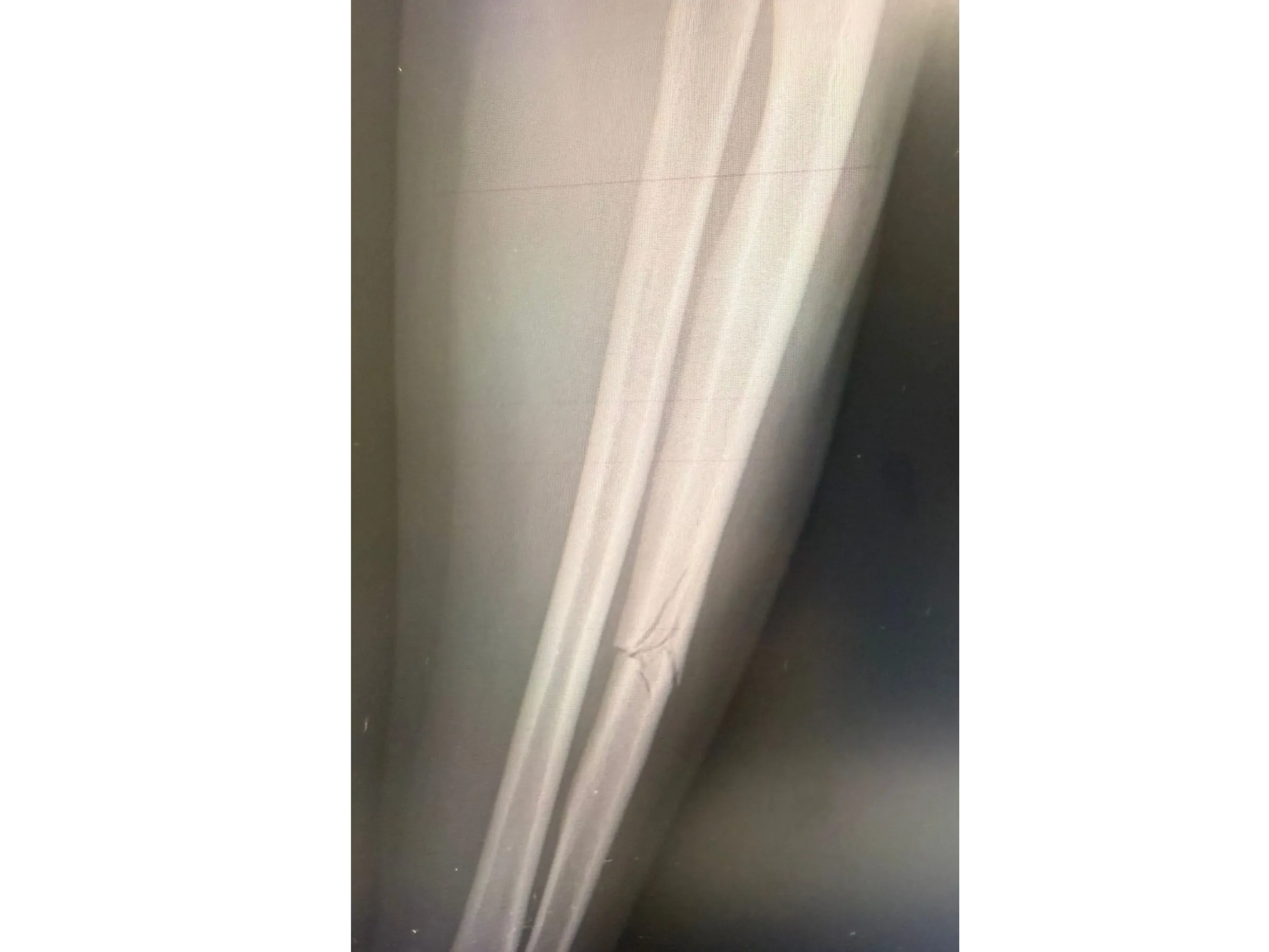 DIÁFISE DA ULNA [Caso 2] · Placa e Parafusos