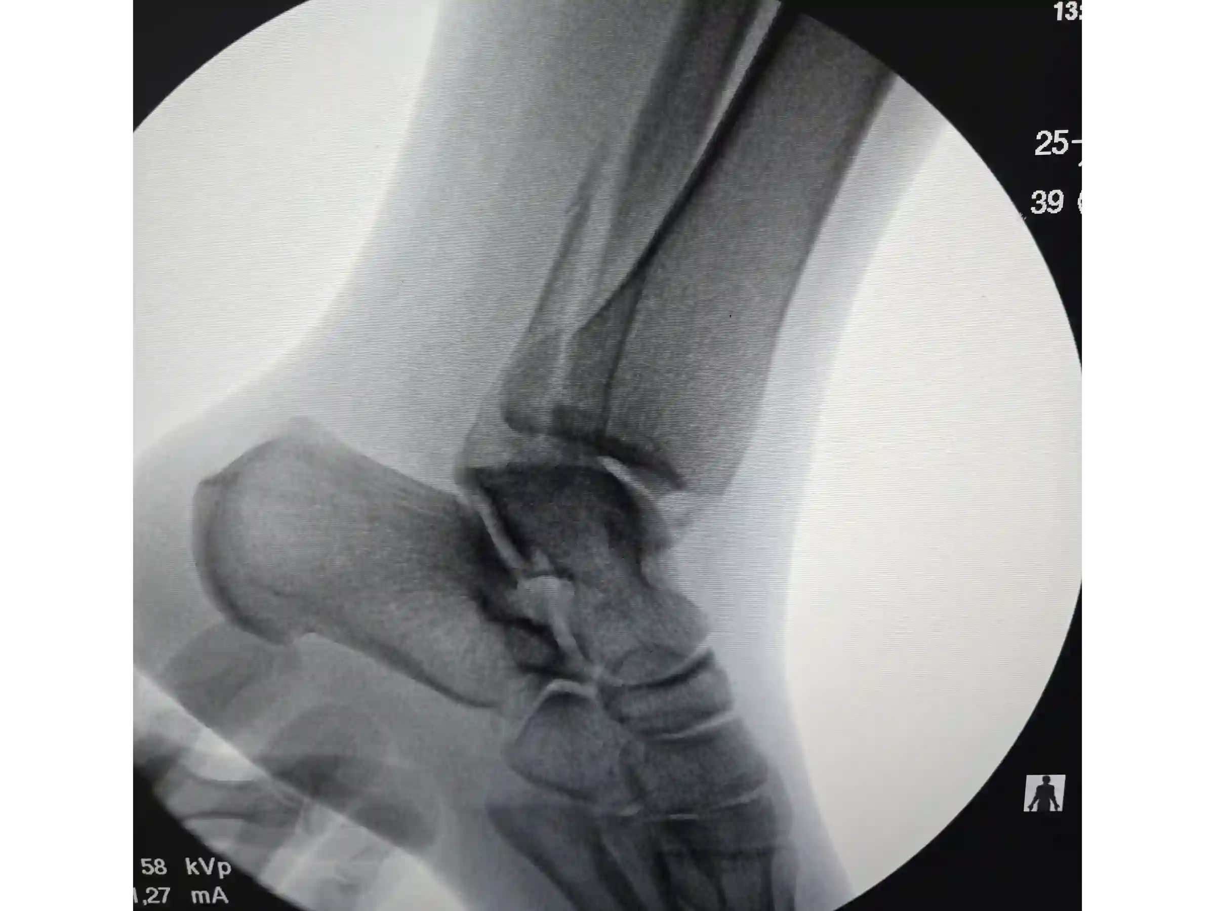 TRIMALEOLAR [CASO 03] Abordagem posterolateral + fixação anterógrada do maléolo medial