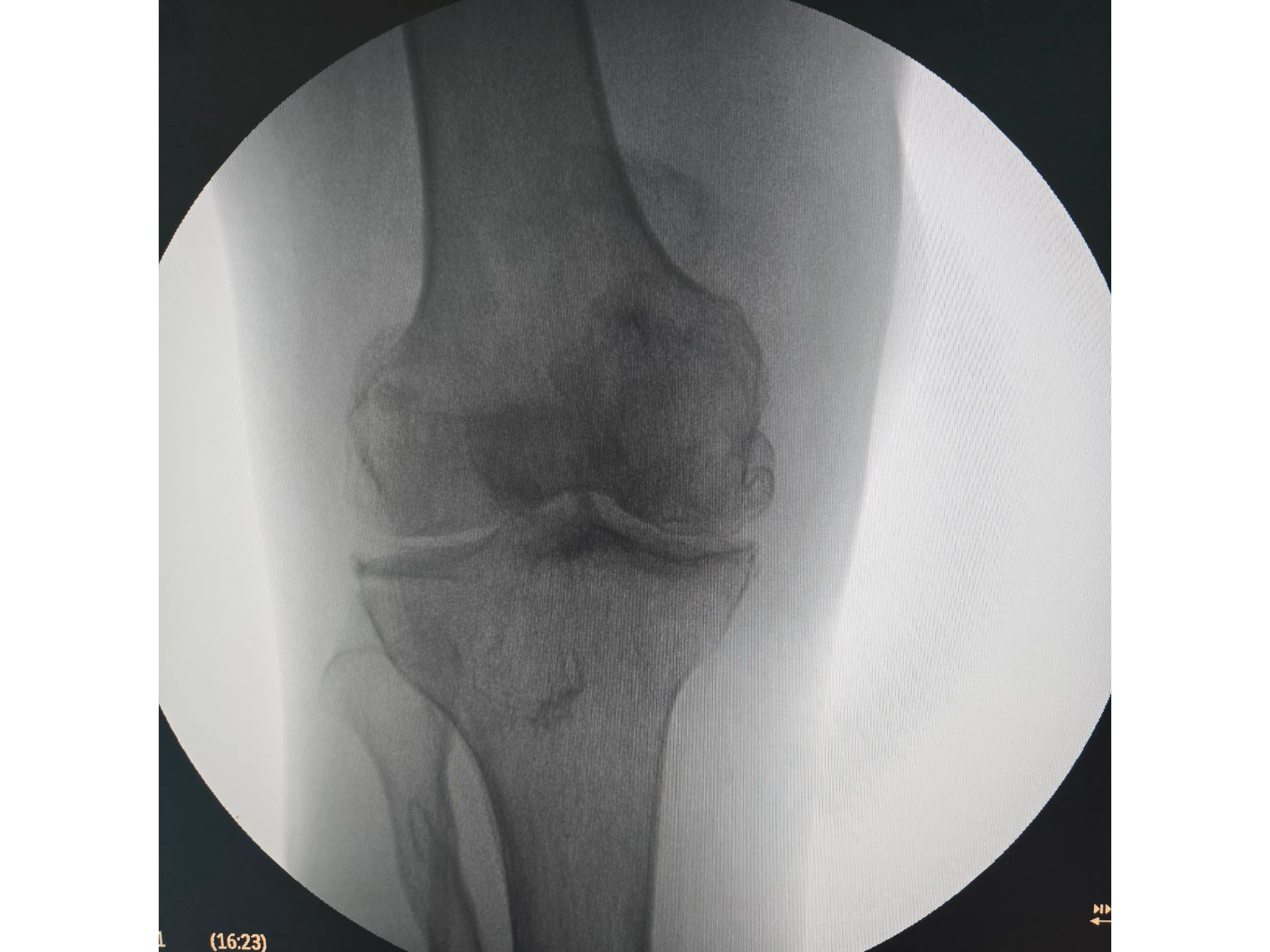 PATELA [Caso 2] · Parafusos Canulados + Cerclagem