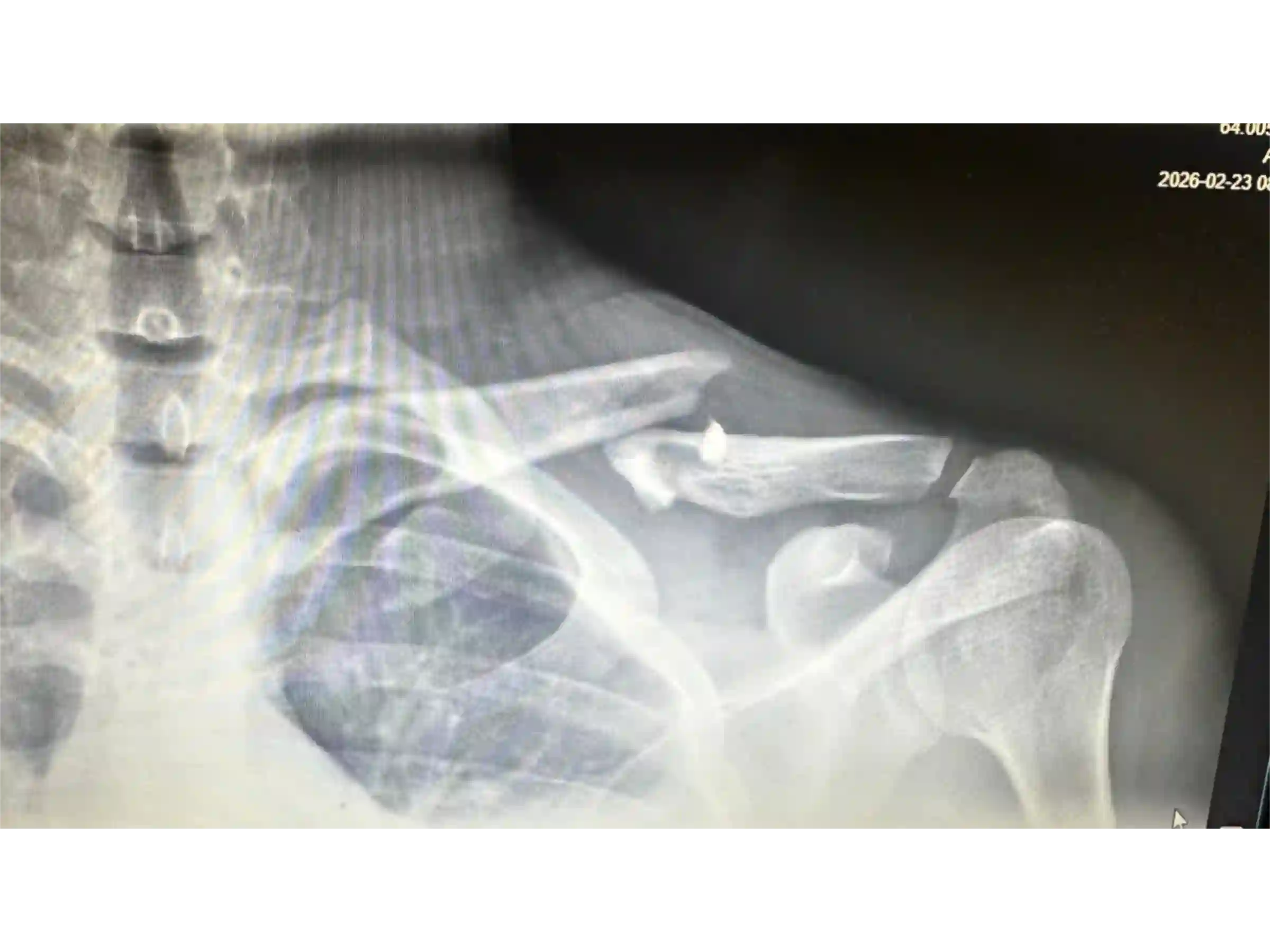 CLAVICLE [CASE 03] - Minimally Invasive Percutaneous Osteosynthesis