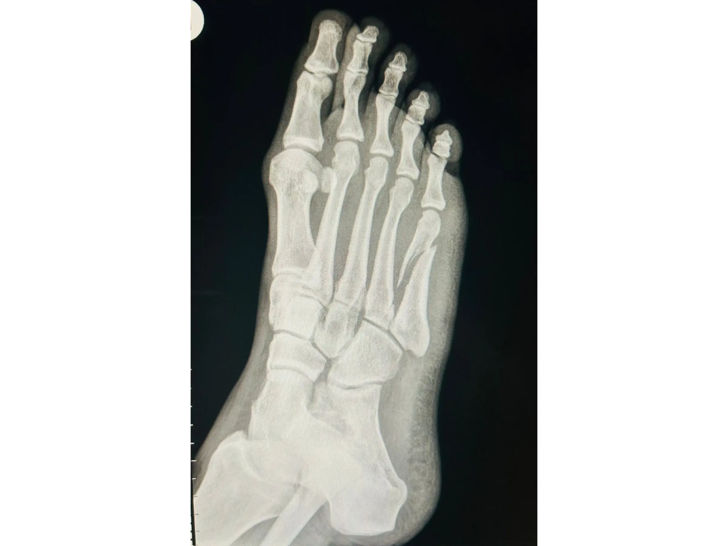 QUINTO METATARSO [Caso 2] · Placa e Parafusos de Minifragmentos