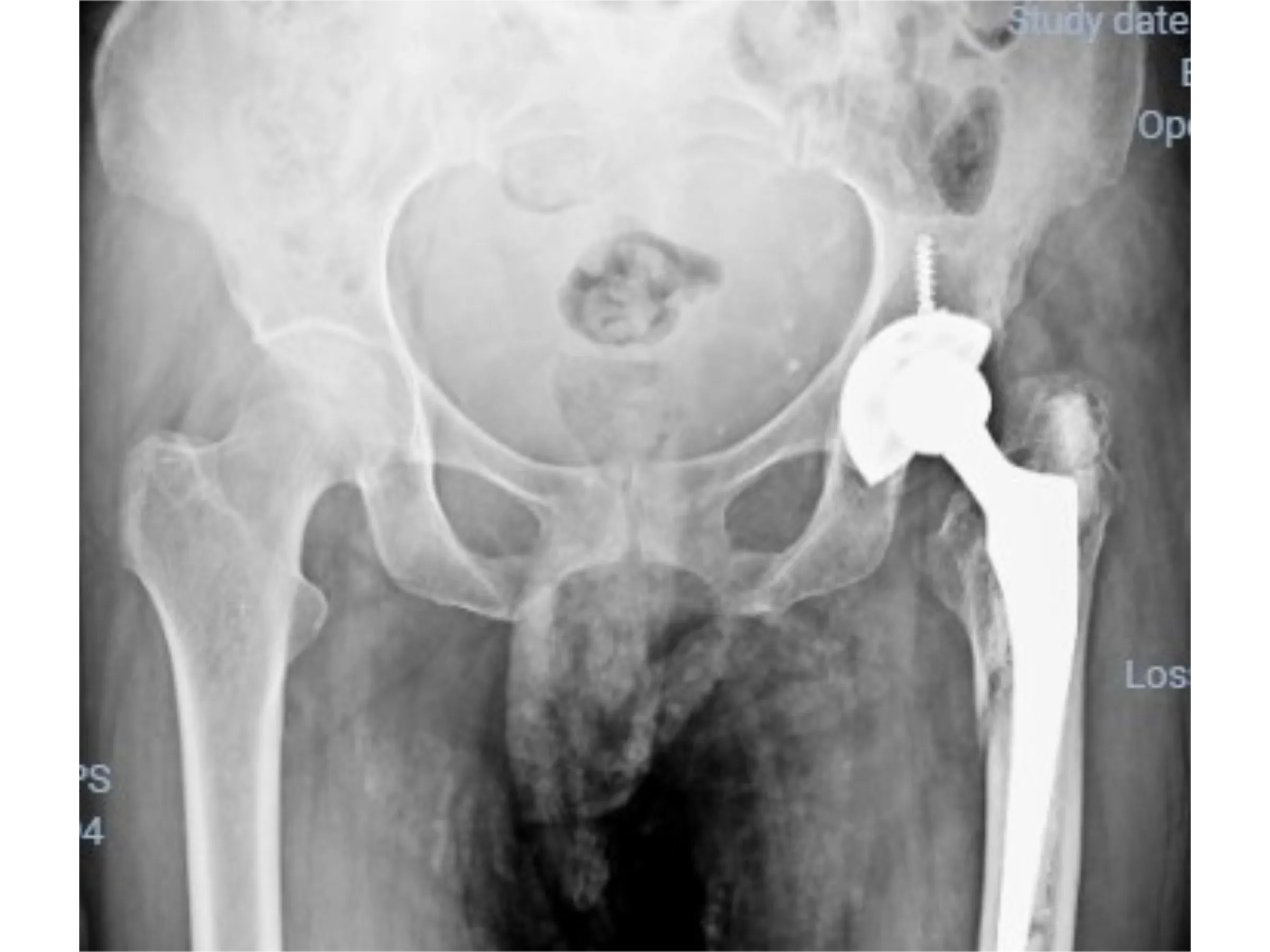 FRATURA PERIPROTÉTICA DO QUADRIL [Caso 1] · Placa Trocantérica + Cerclagem