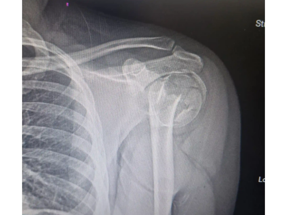 ÚMERO PROXIMAL [CASO 07] - Head-Split Em Paciente Jovem Placa E Parafusos