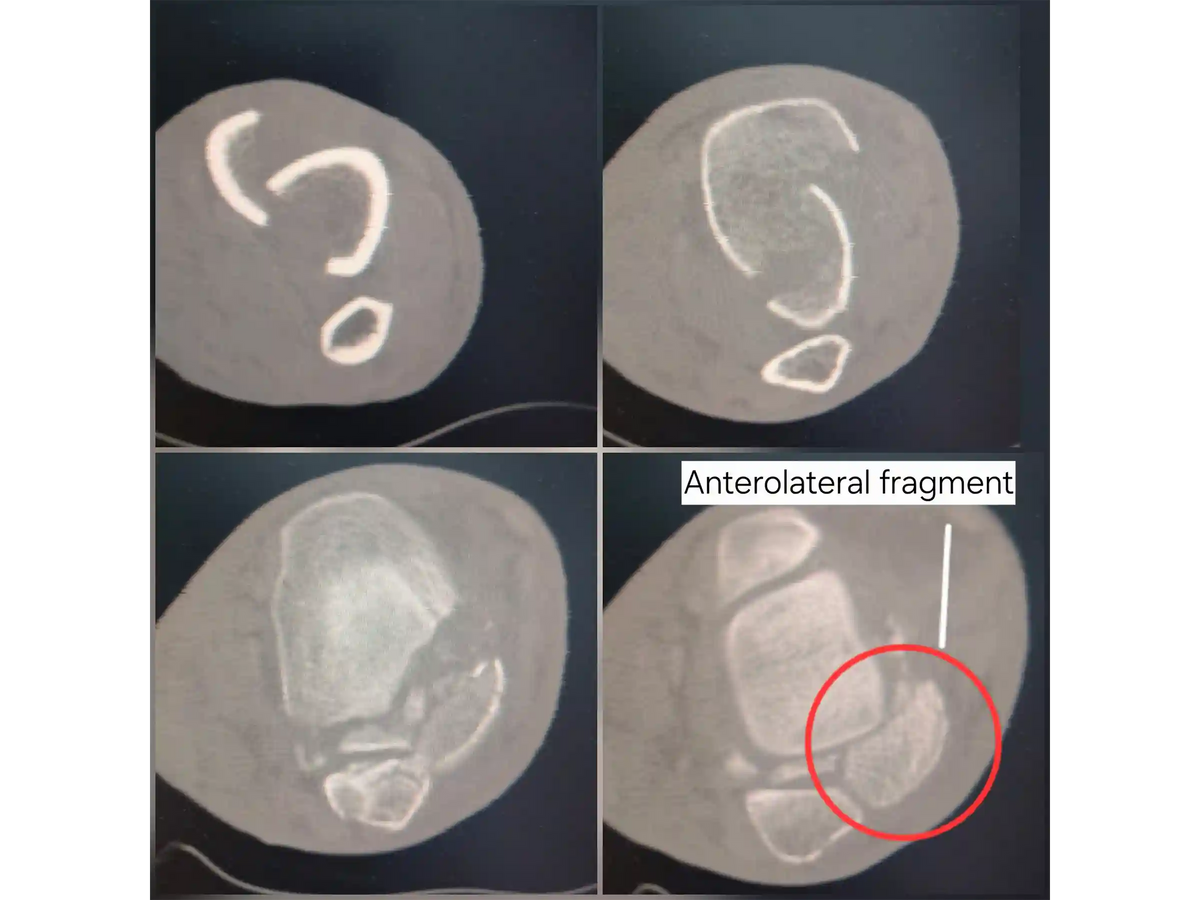 PILÃO TIBIAL [CASO 03] Abordagem Anterolateral e Posteromedial